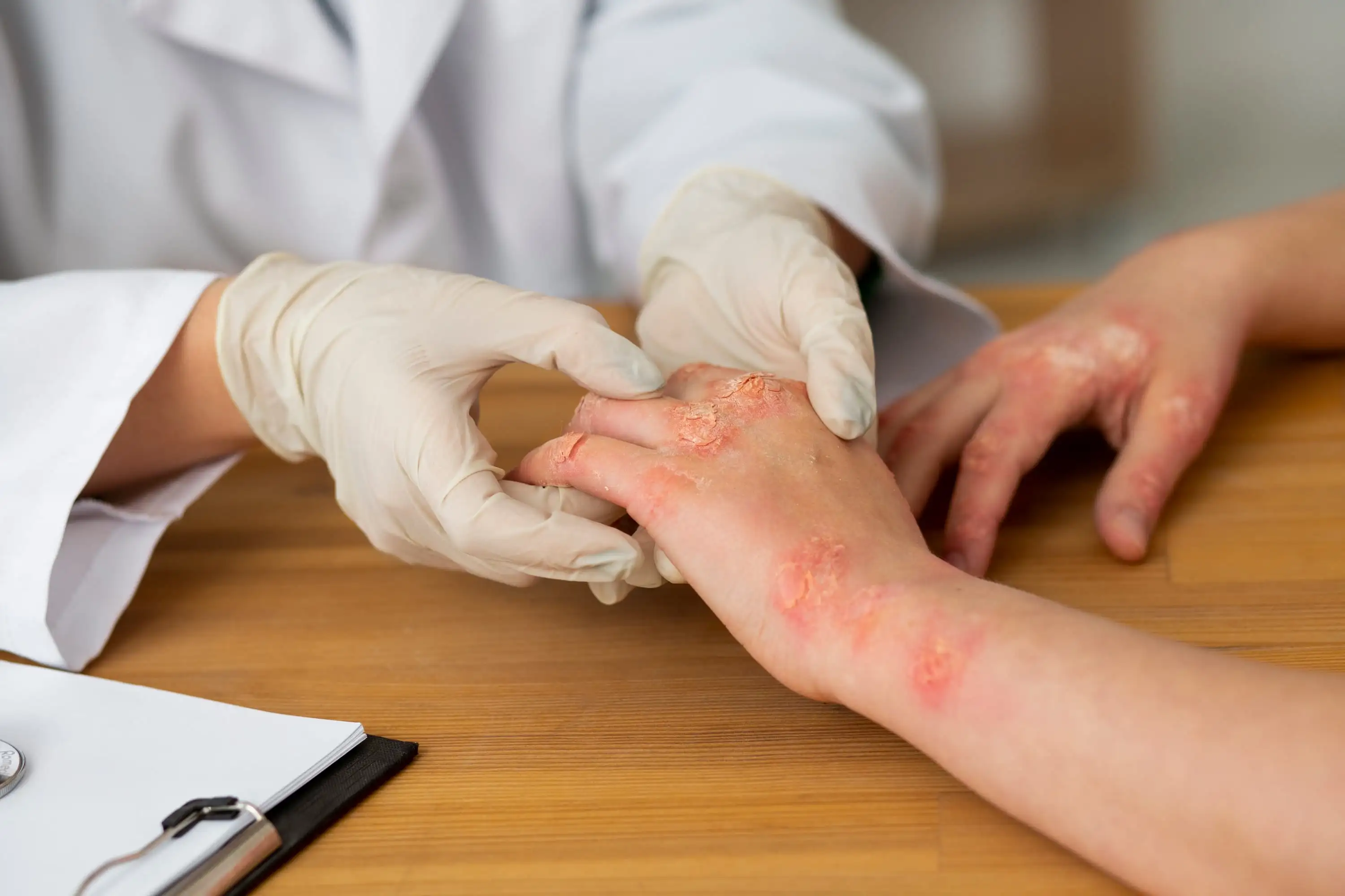 Atopic dermatitis