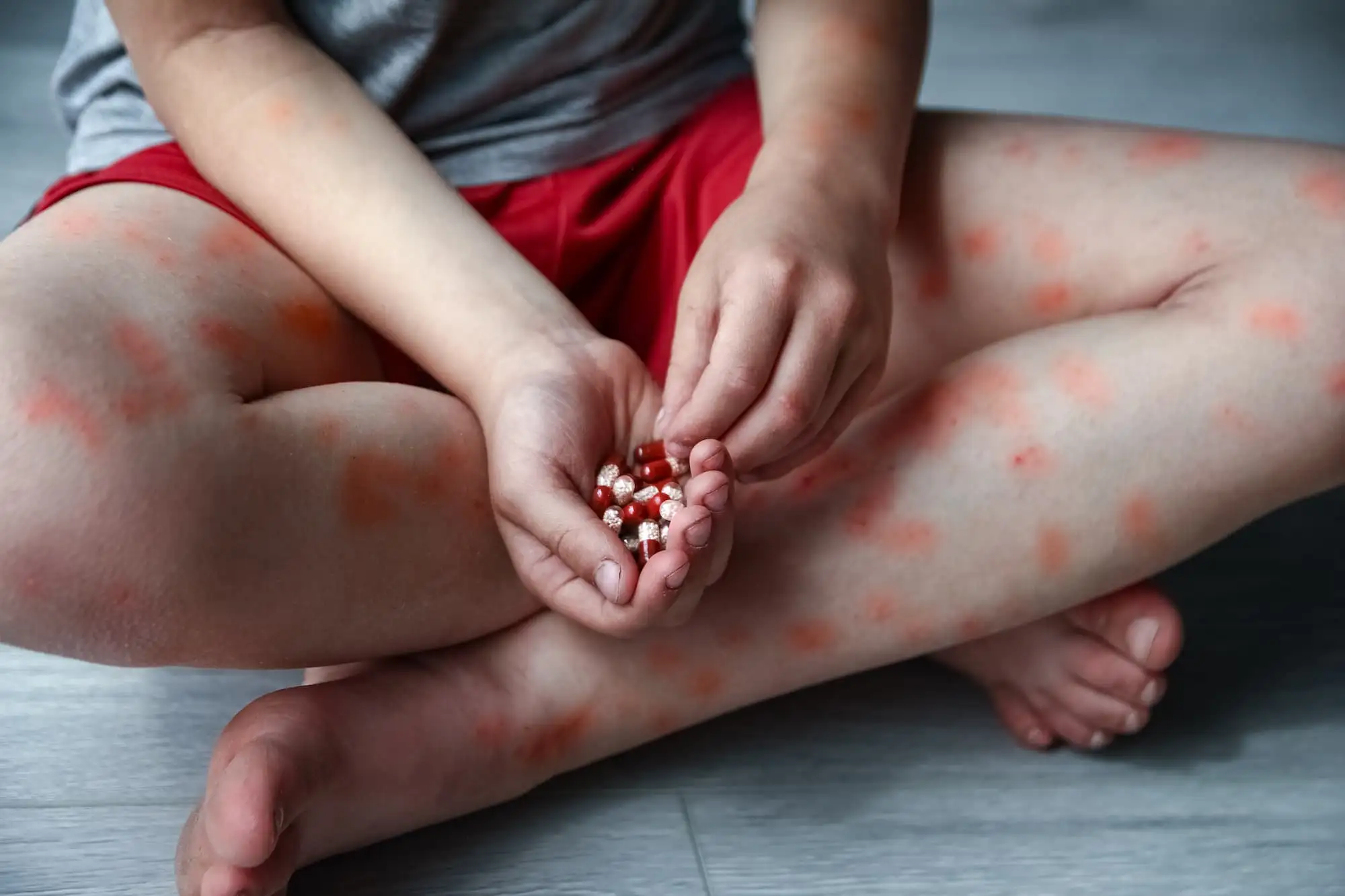 Atopic dermatitis