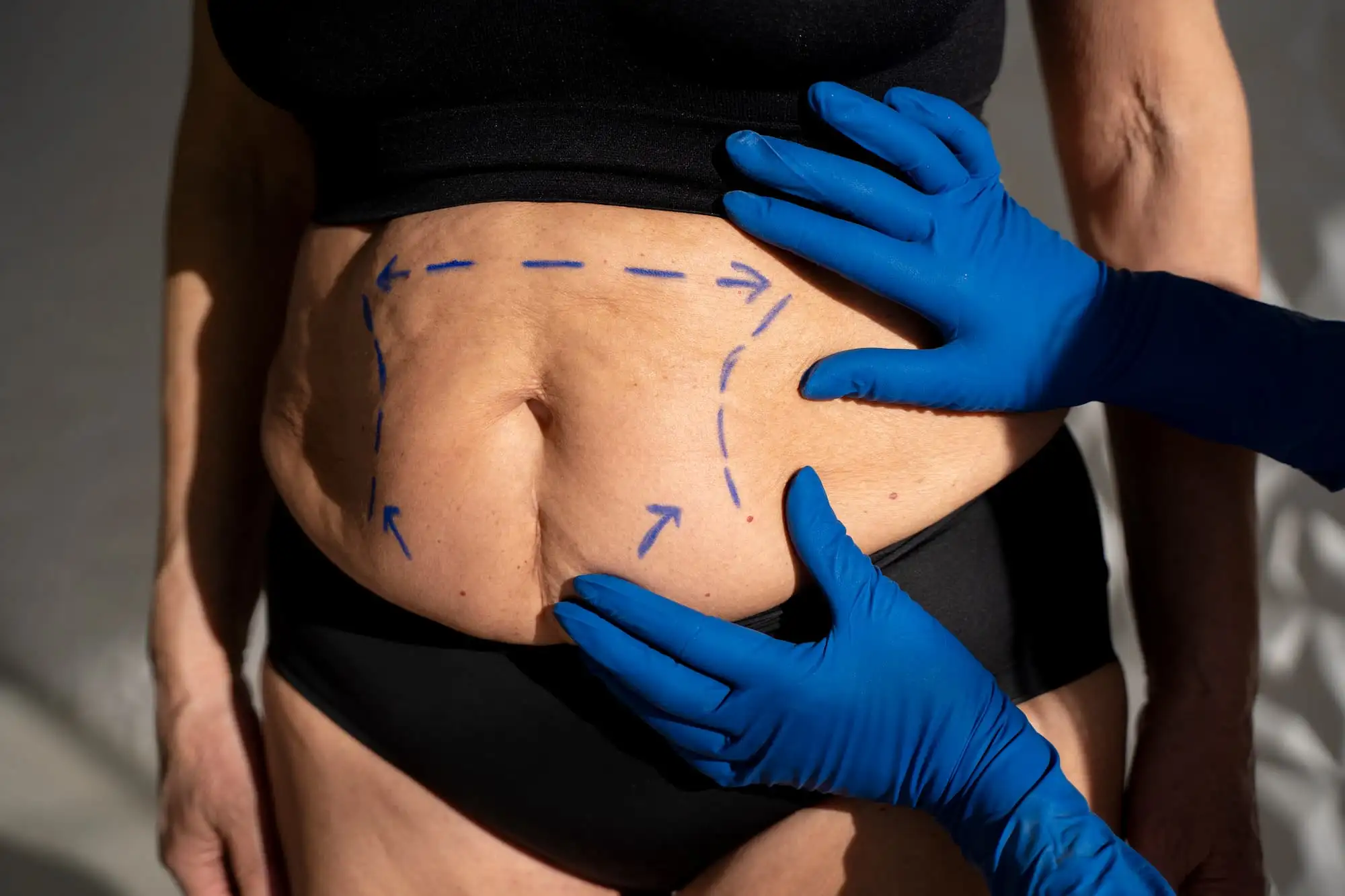 Obesity, Bariatric surgery