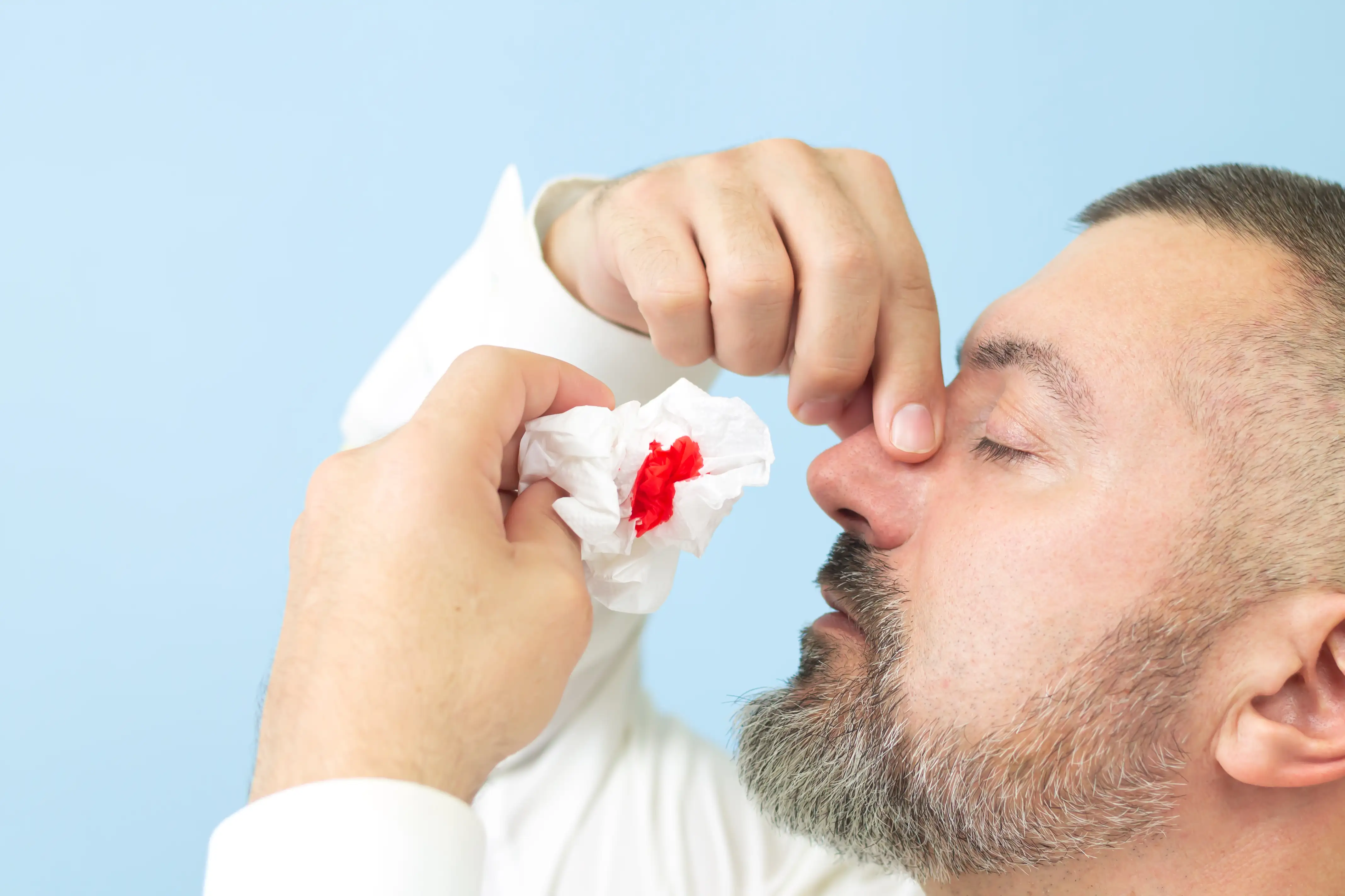 Epistaxis
