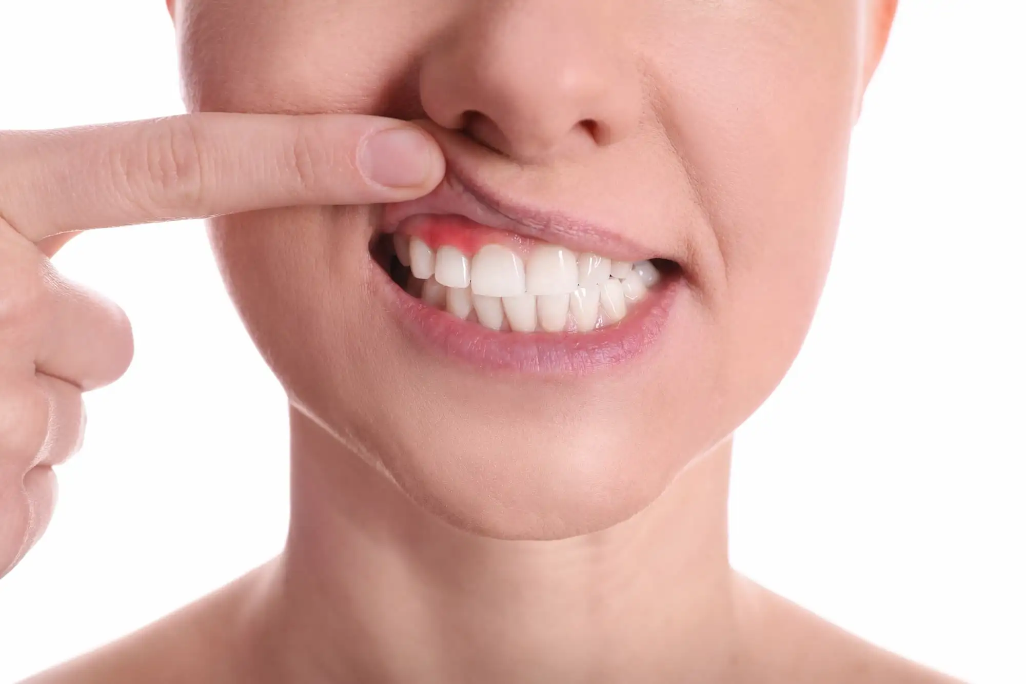 Desquamative gingivitis
