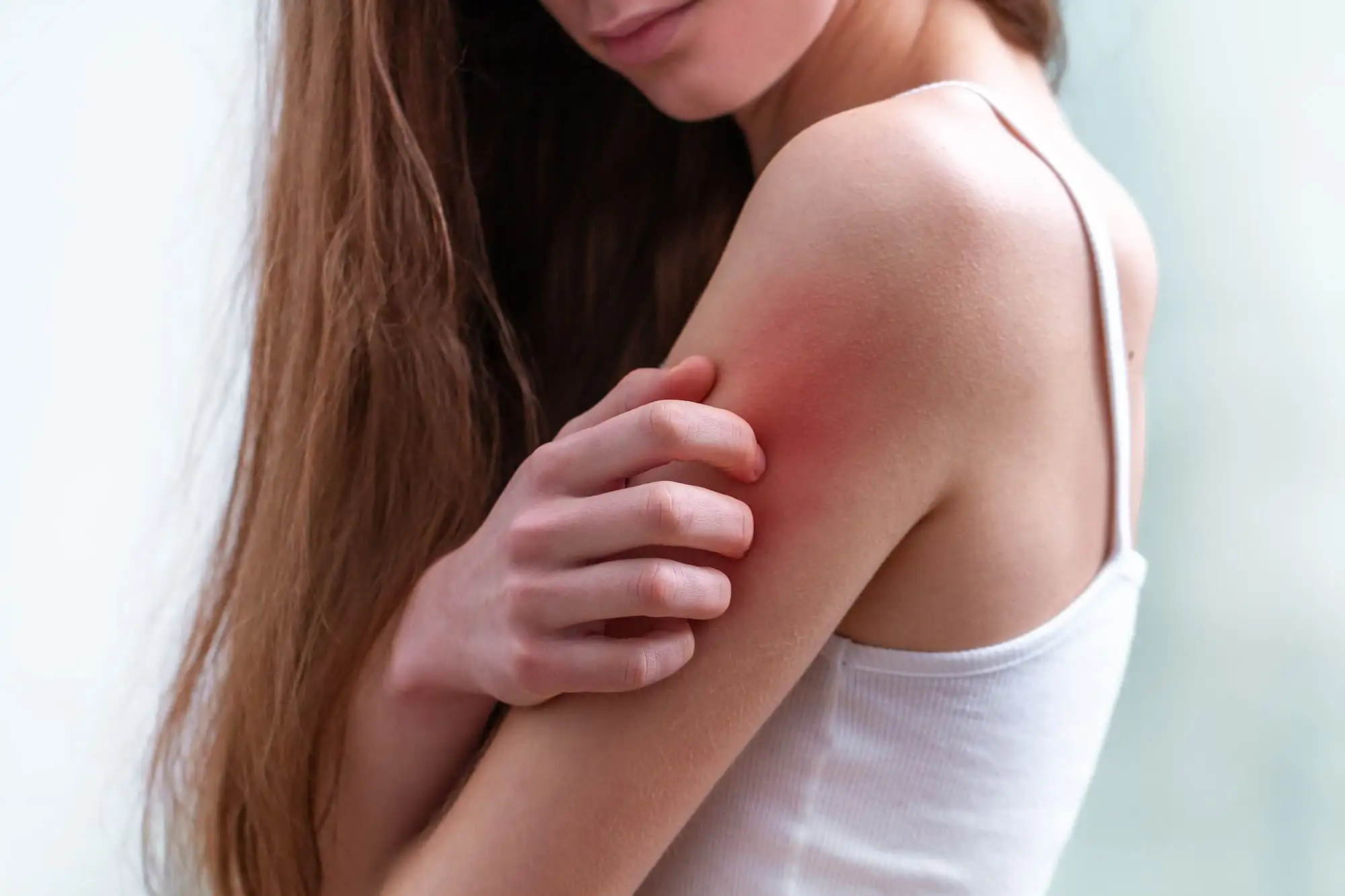 CKD-associated pruritus