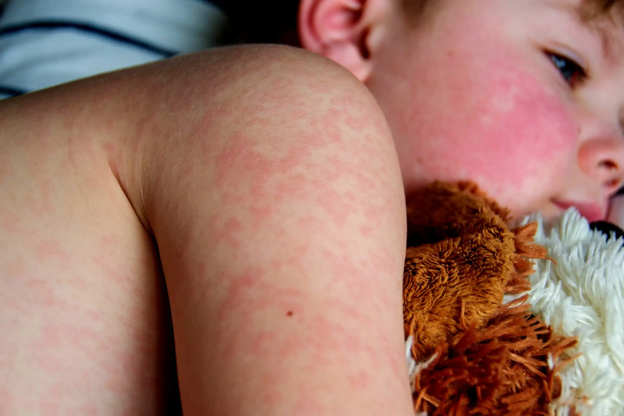 Atopic dermatitis in pediatrics