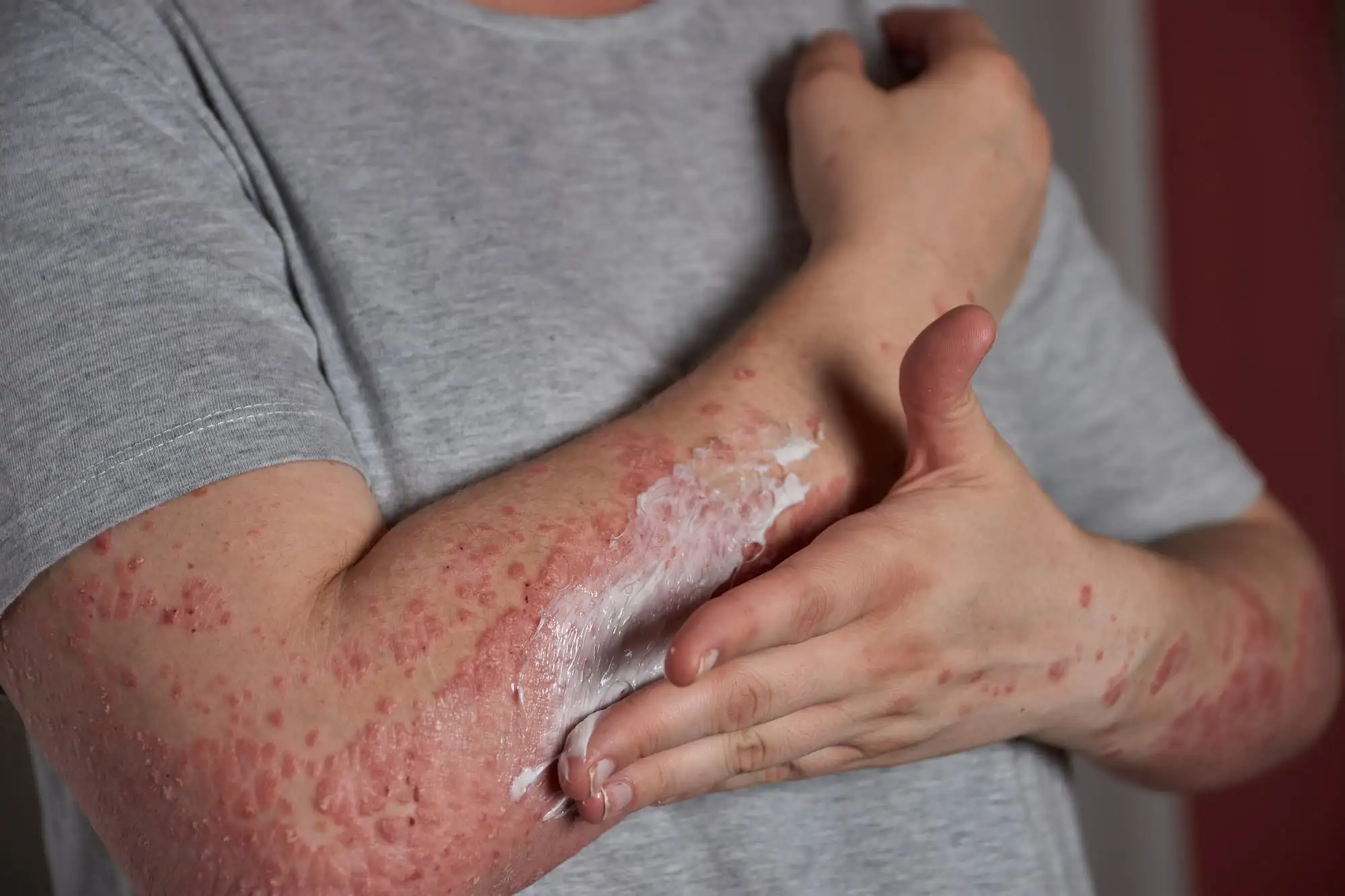 Chronic spontaneous urticaria