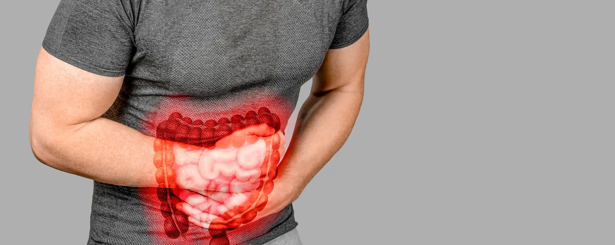 Erosive esophagitis