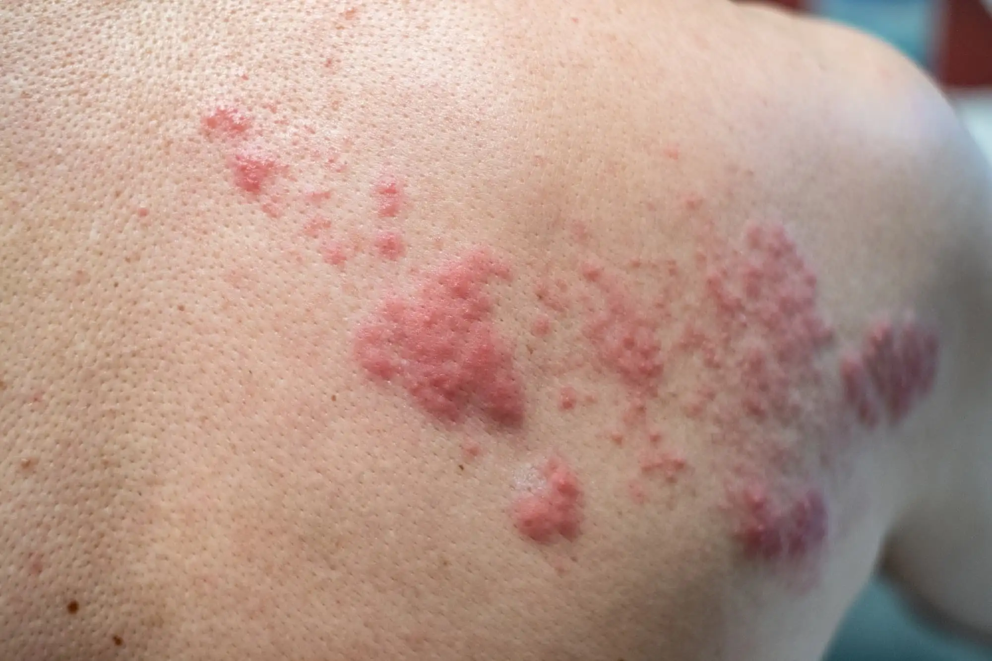 Chronic spontaneous urticaria