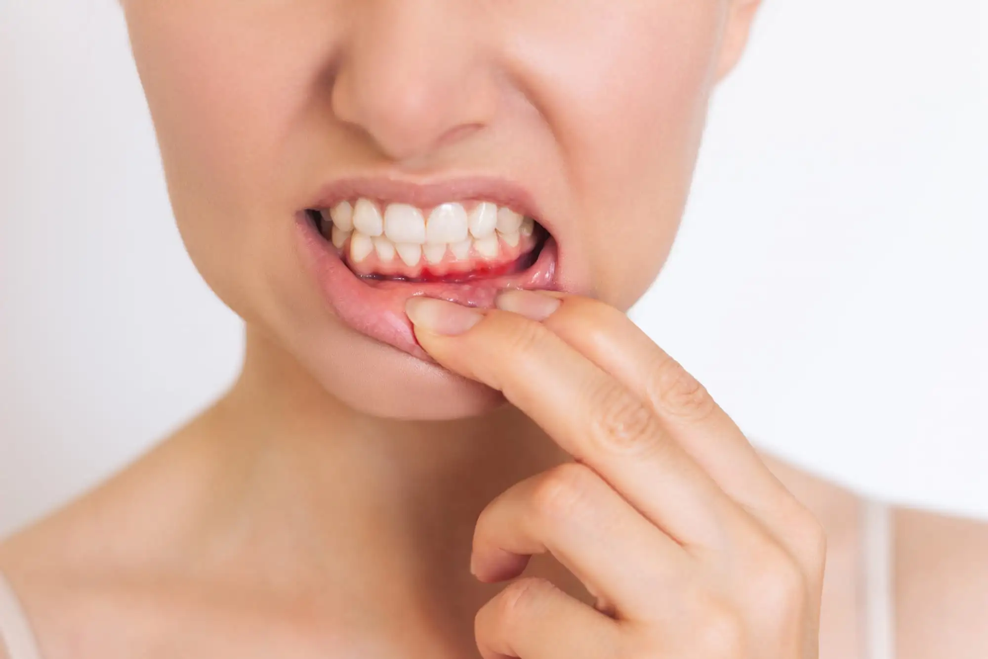 Gingivitis