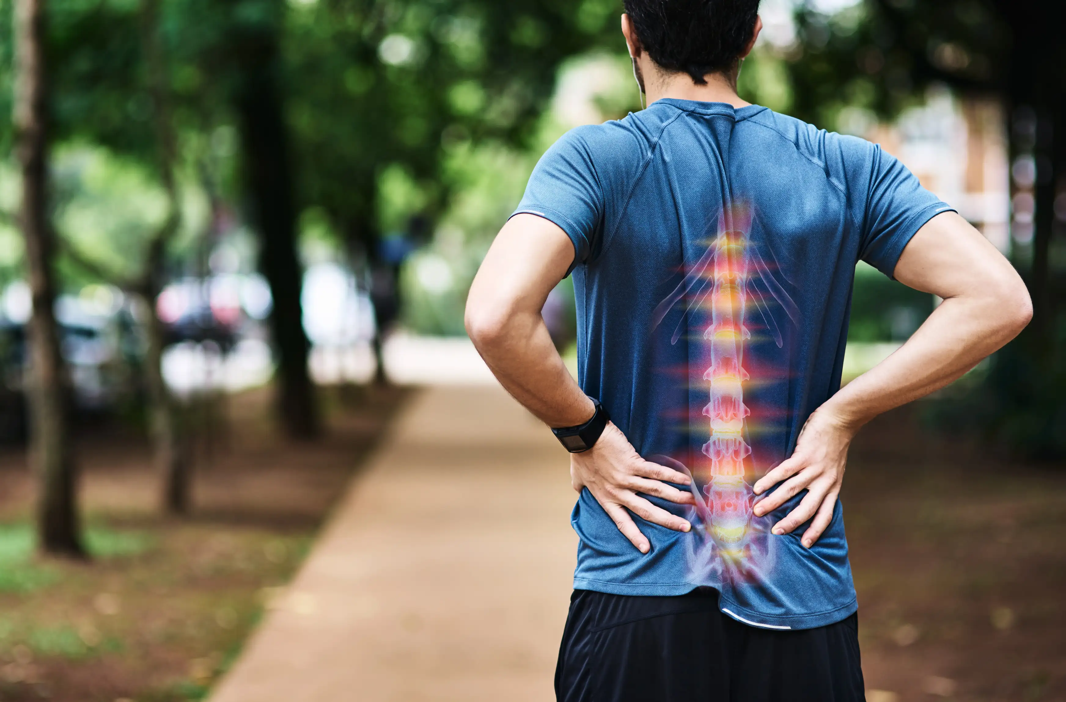 Sciatica, Lumbar disc herniation