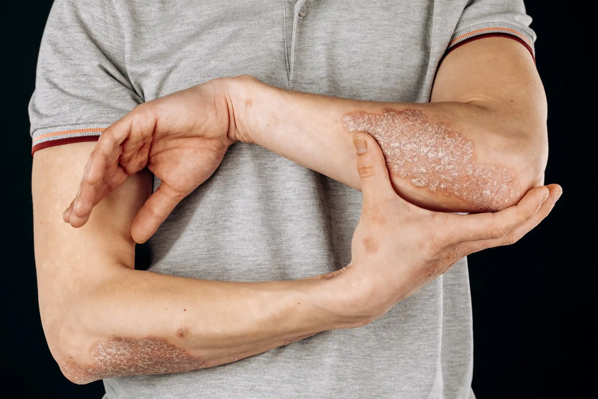 Atopic dermatitis