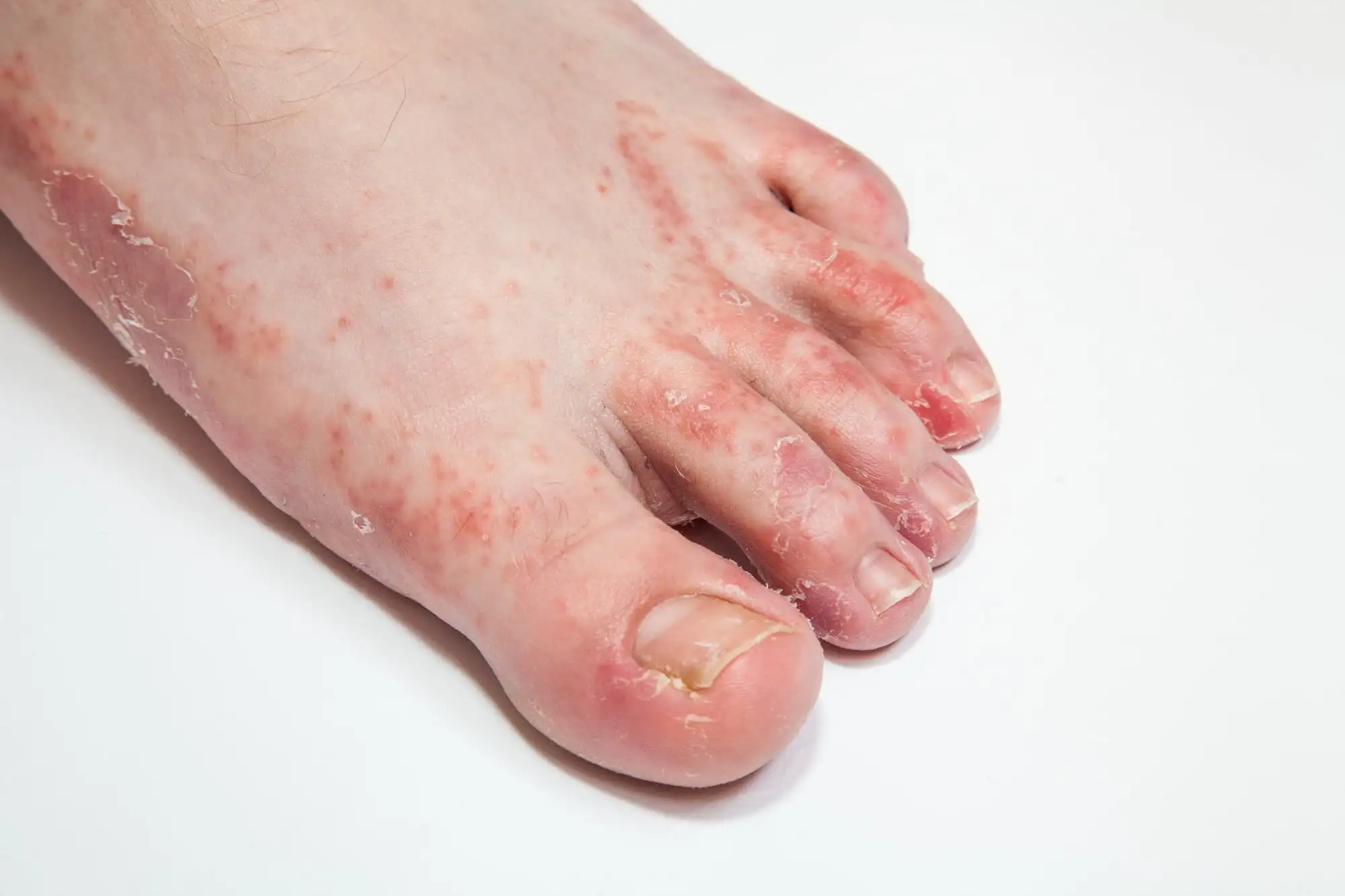 Keratotic tinea pedis