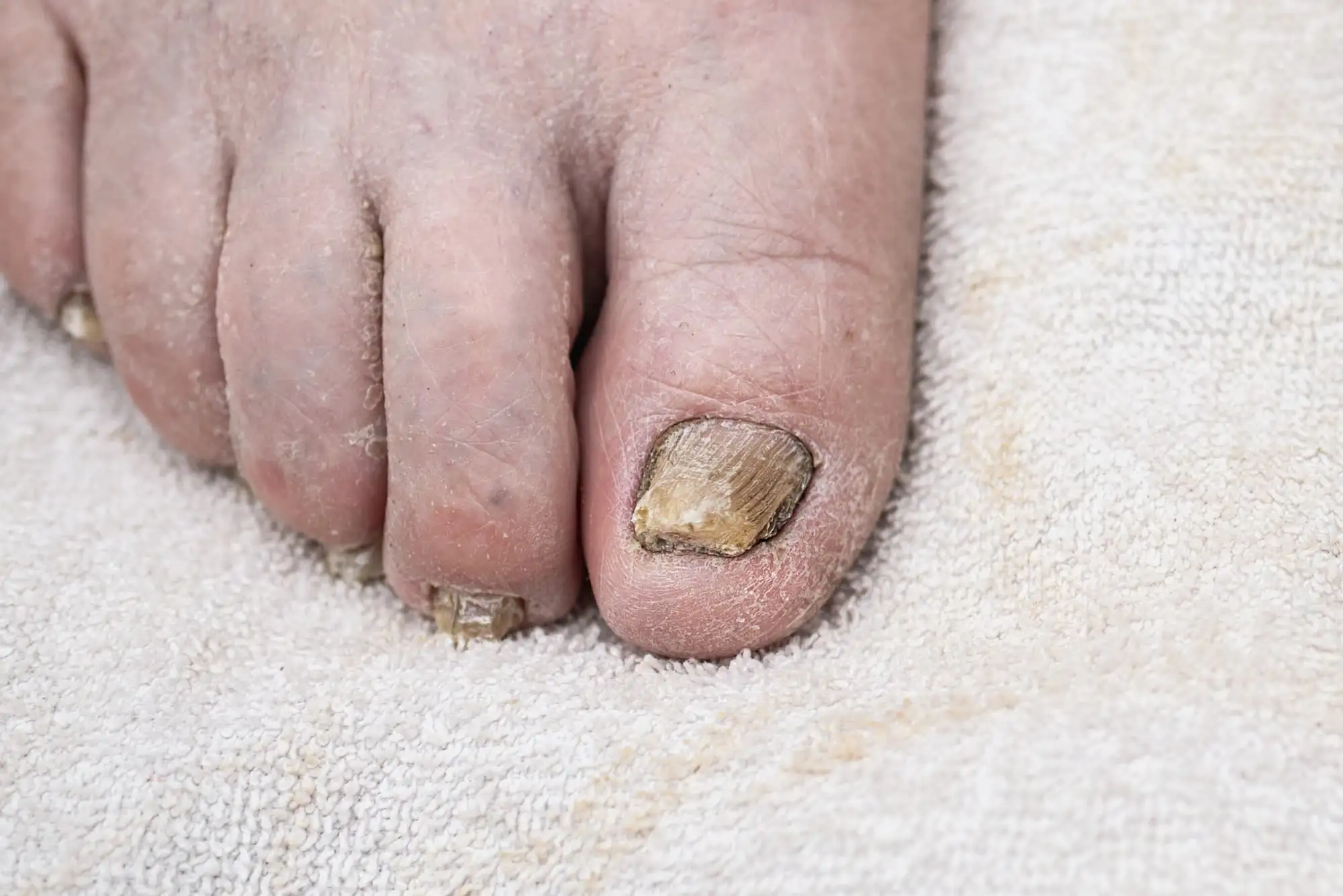Onychomycosis