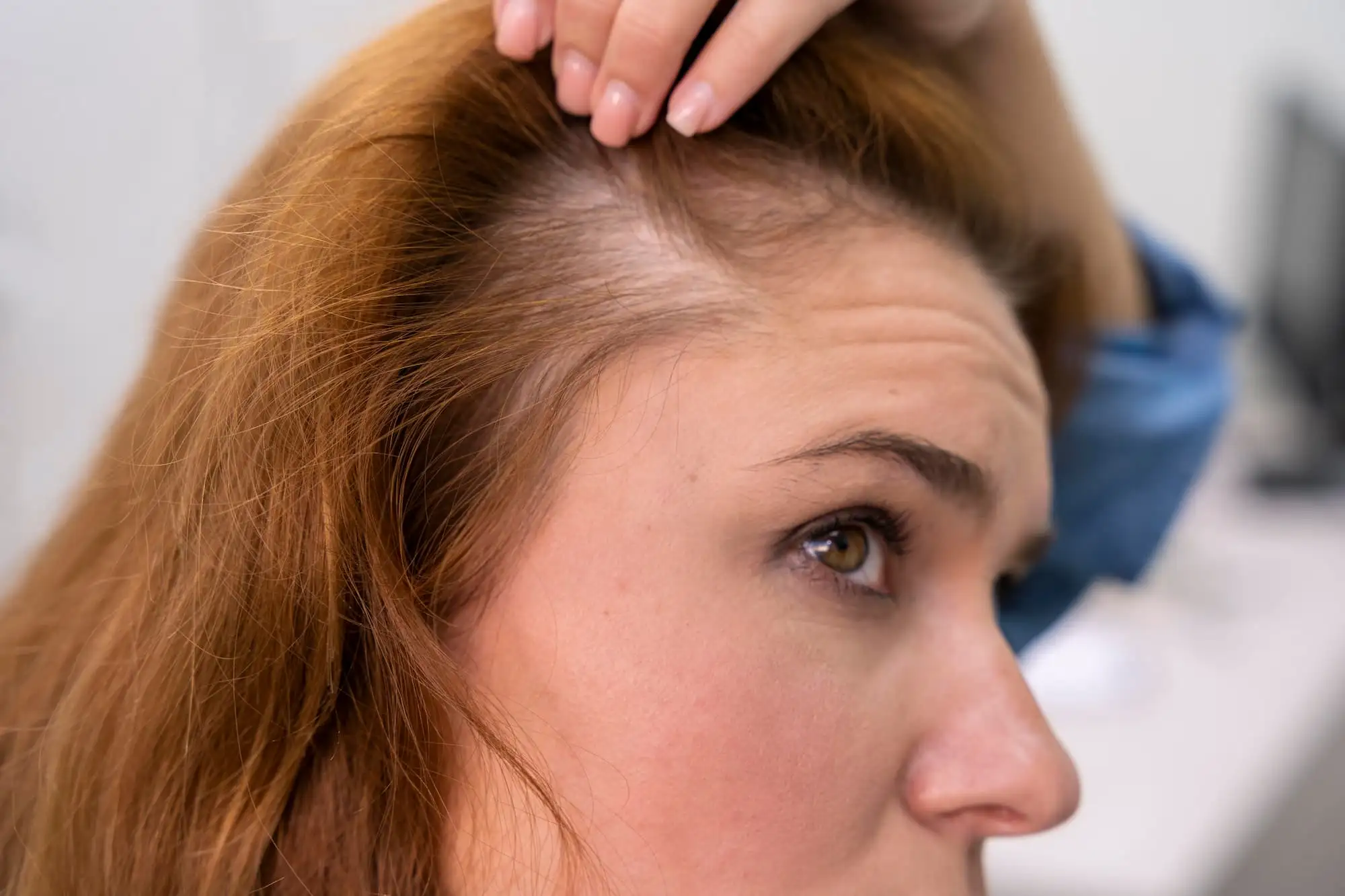 Alopecia areata