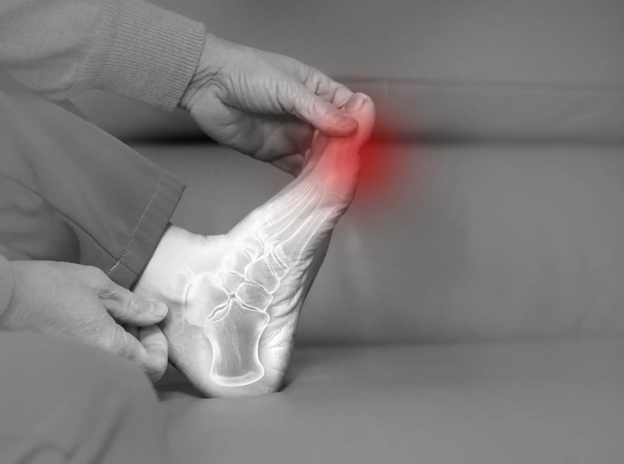 Talus osteoarthritis