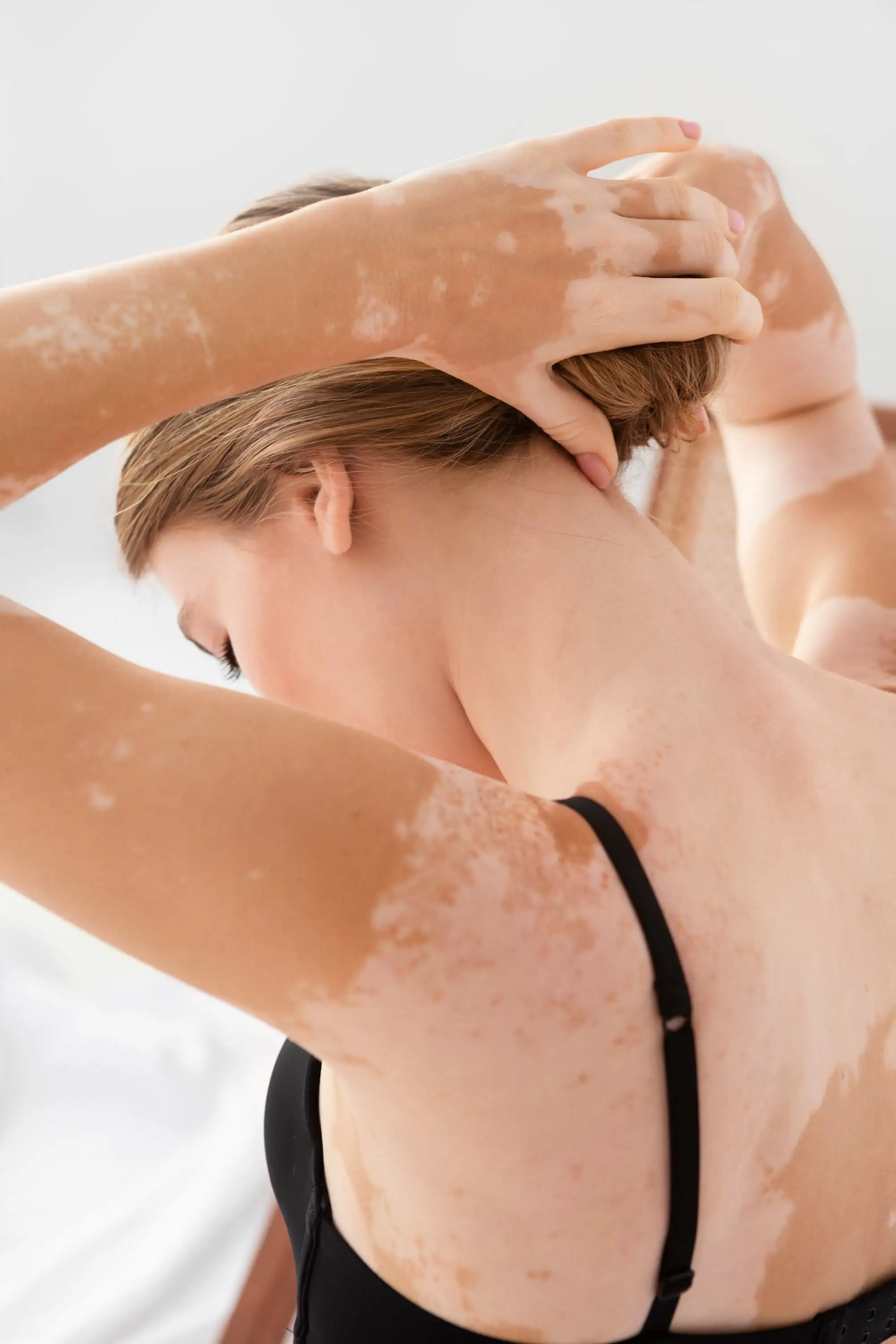 Non-segmental vitiligo