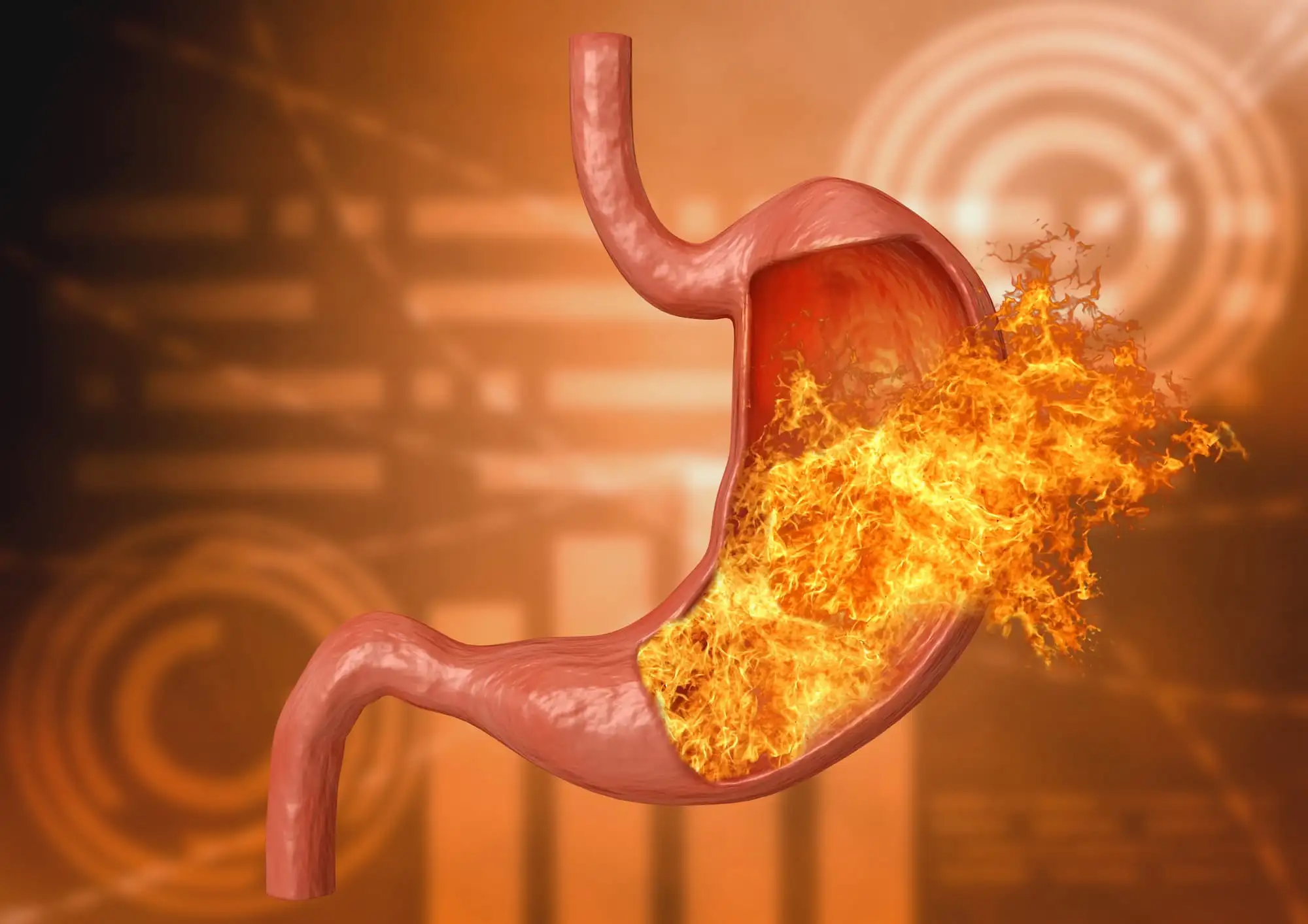 Gastric ulcers