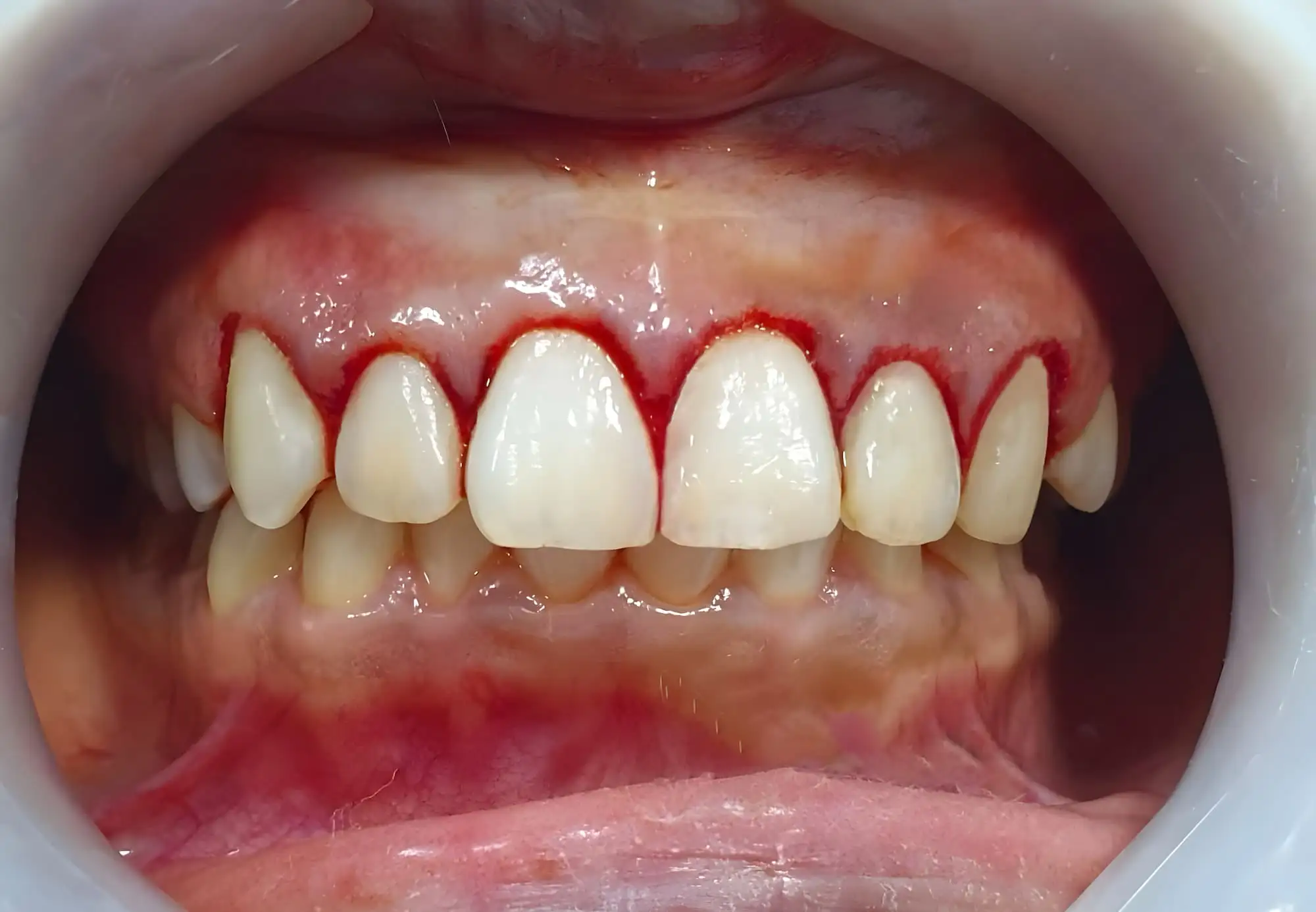 Periodontitis