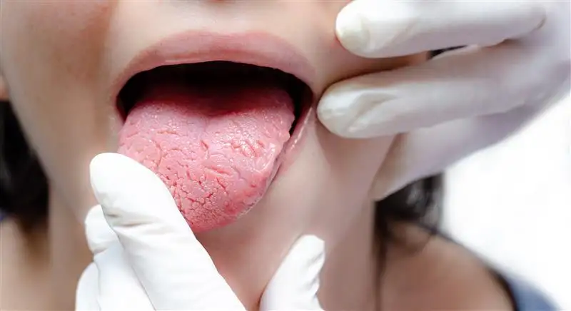 Oral lichen planus