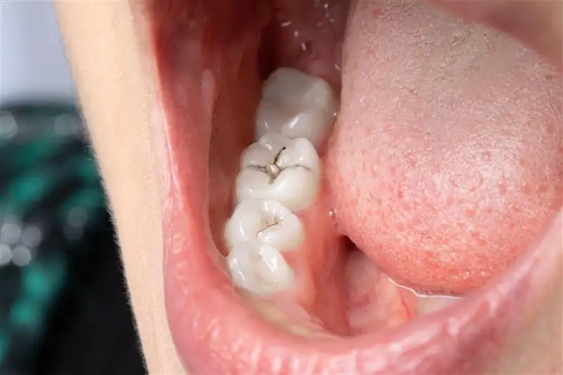 Dental caries
