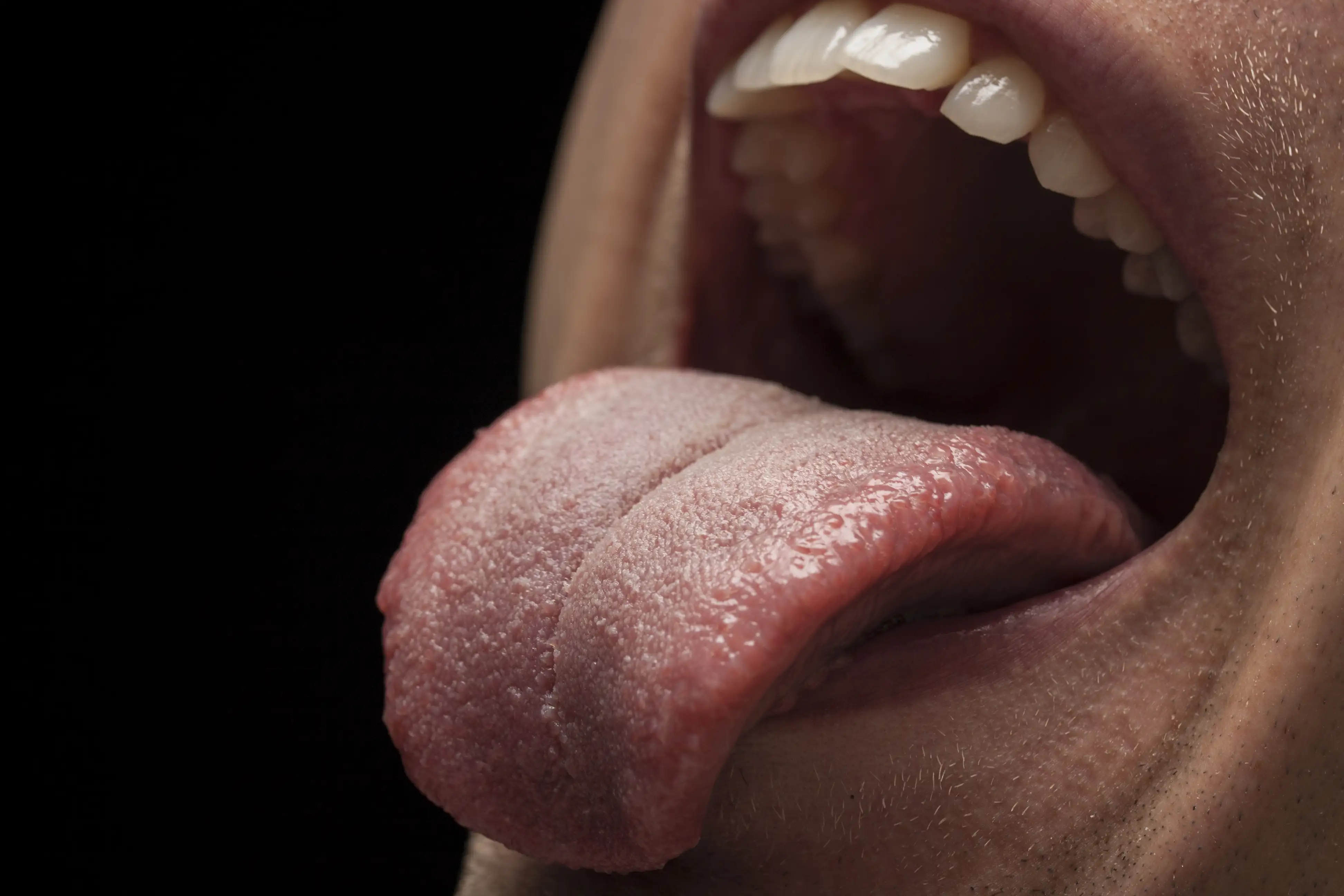 Polypharmacy-induced xerostomia