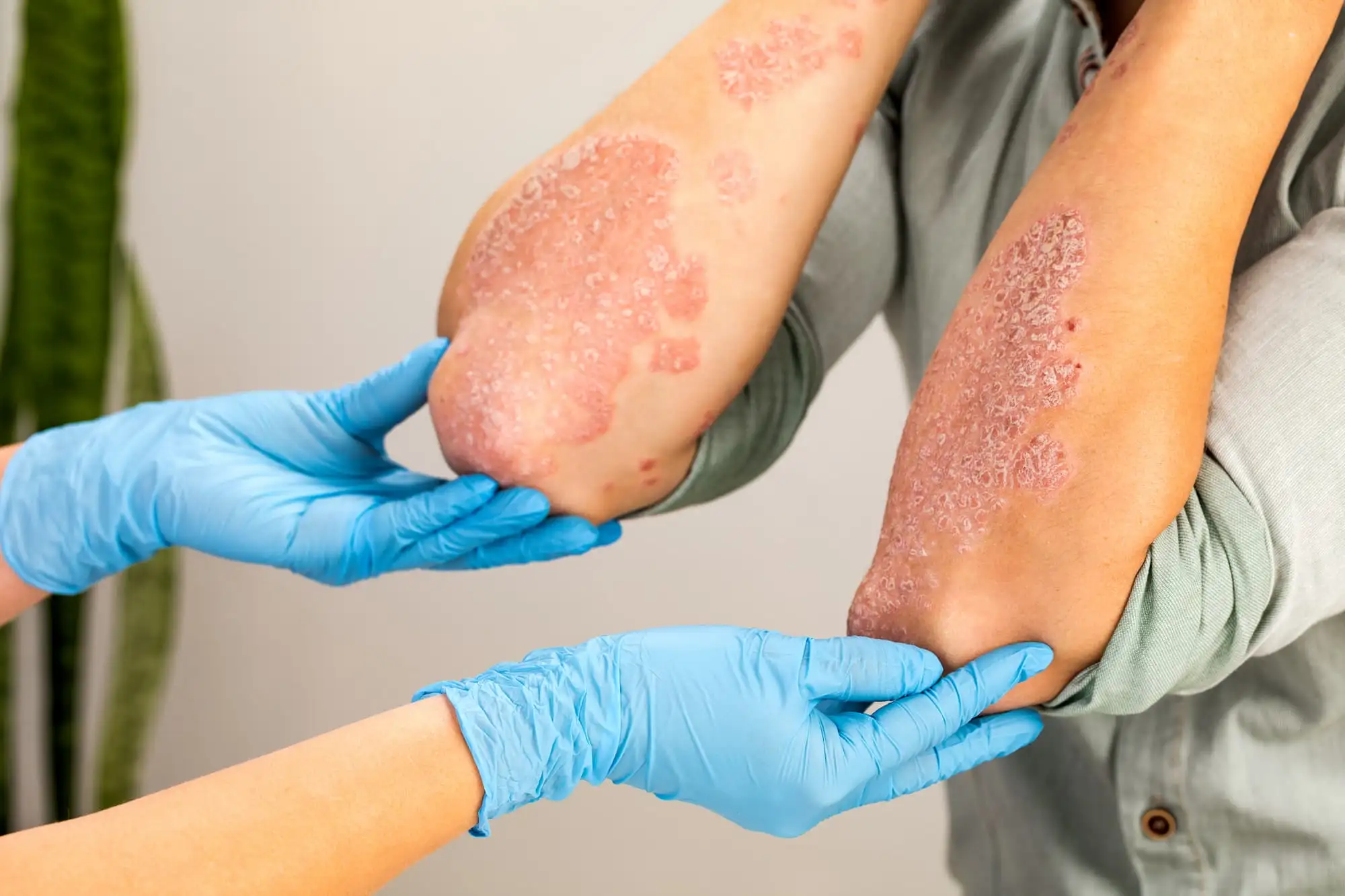 Atopic dermatitis