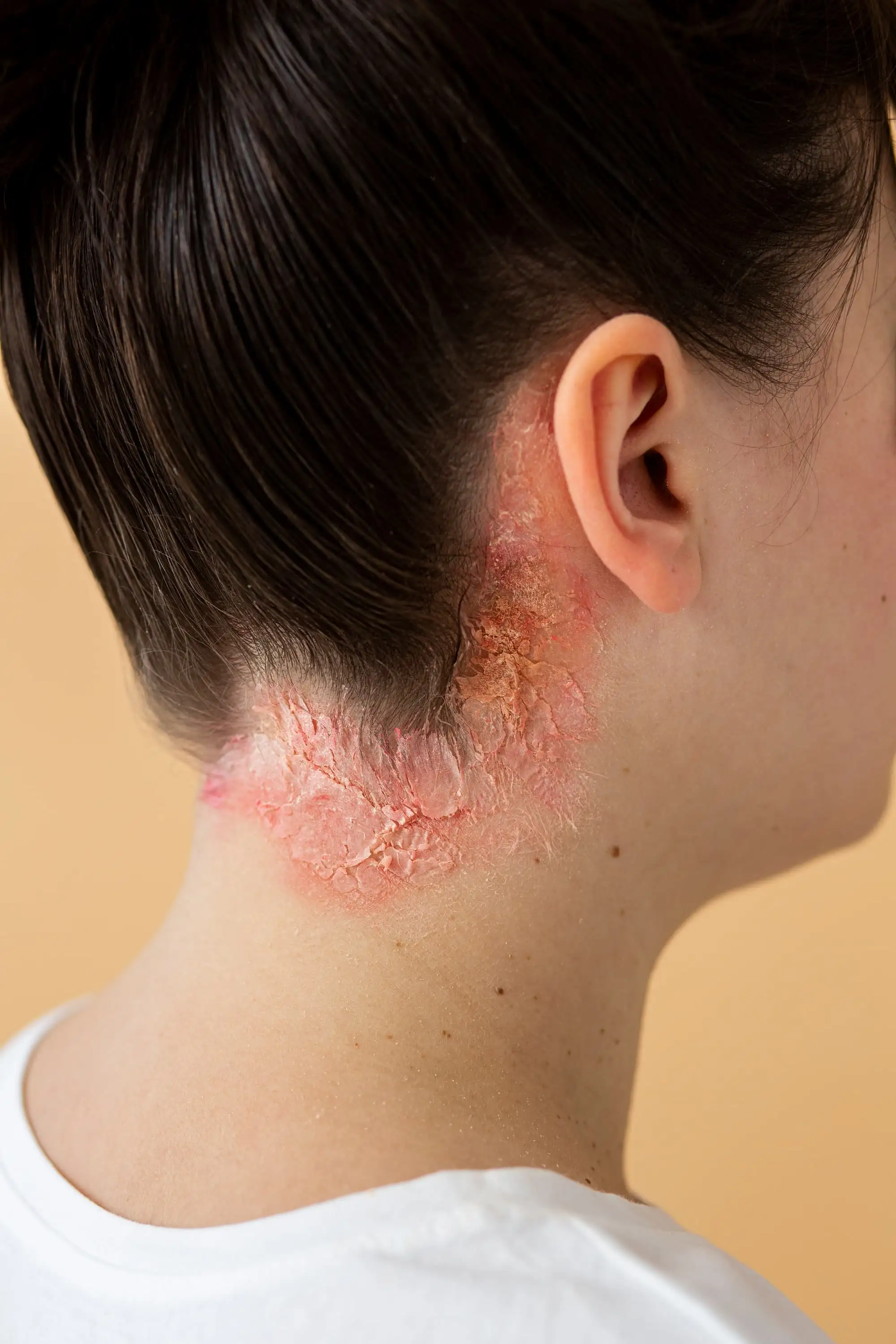 Contact dermatitis, Atopic dermatitis