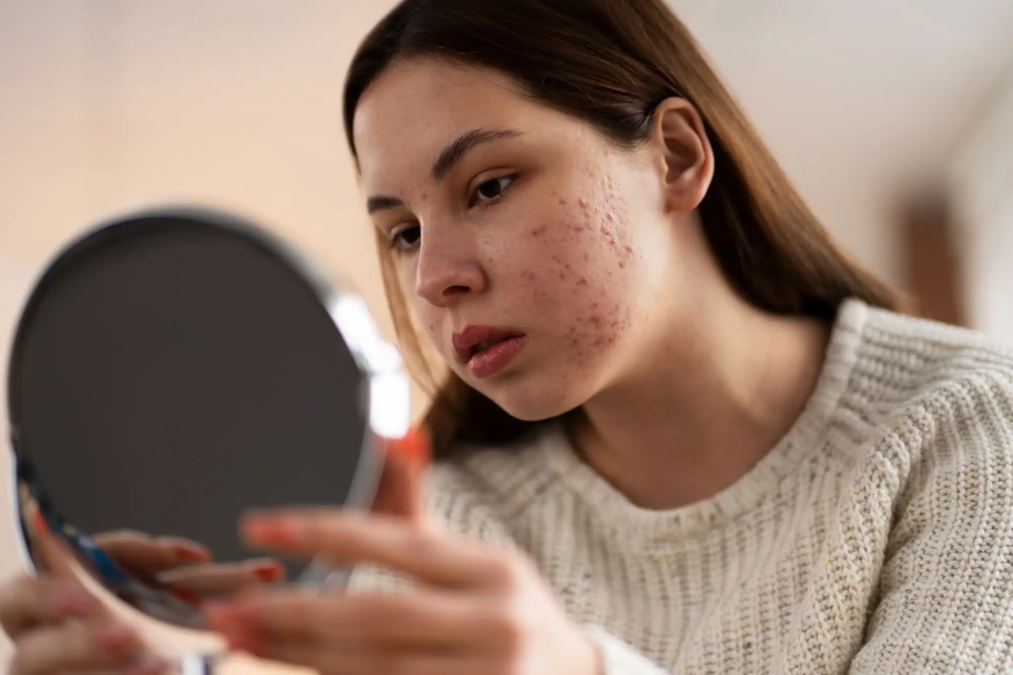 Moderate-to-severe acne