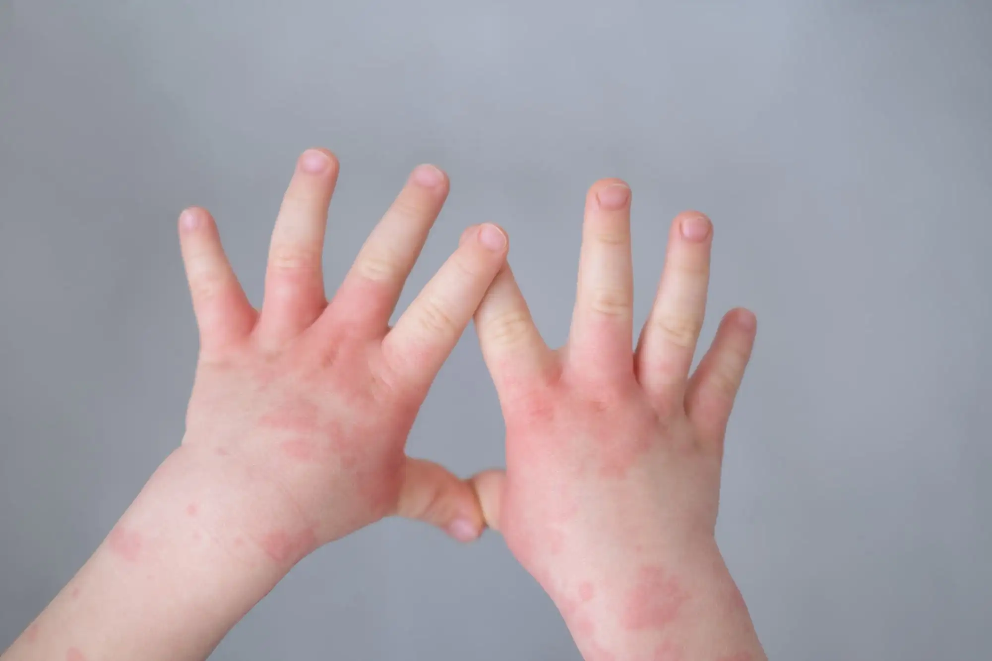 Atopic dermatitis