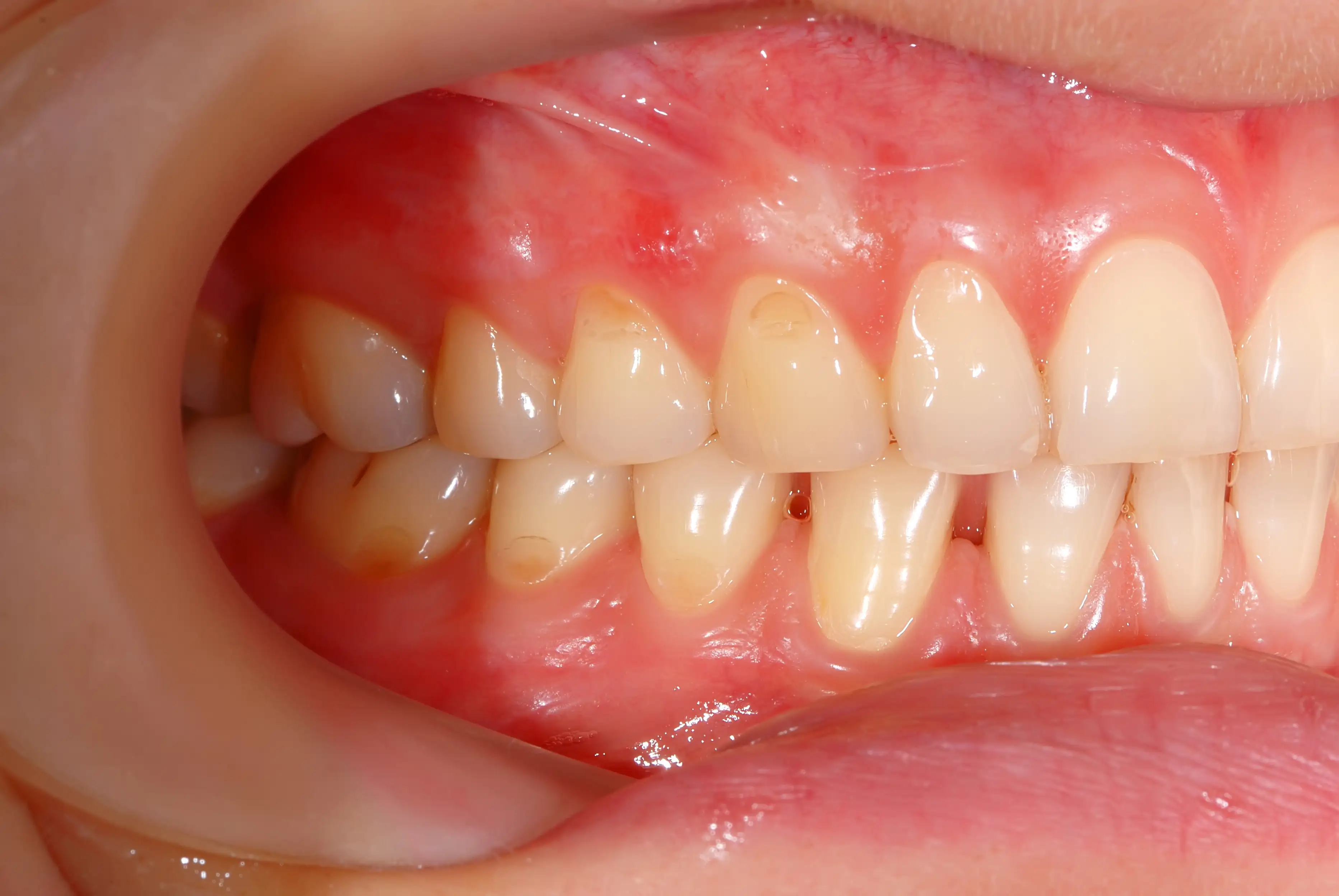 Chronic periodontitis, Non-alcoholic fatty liver disease