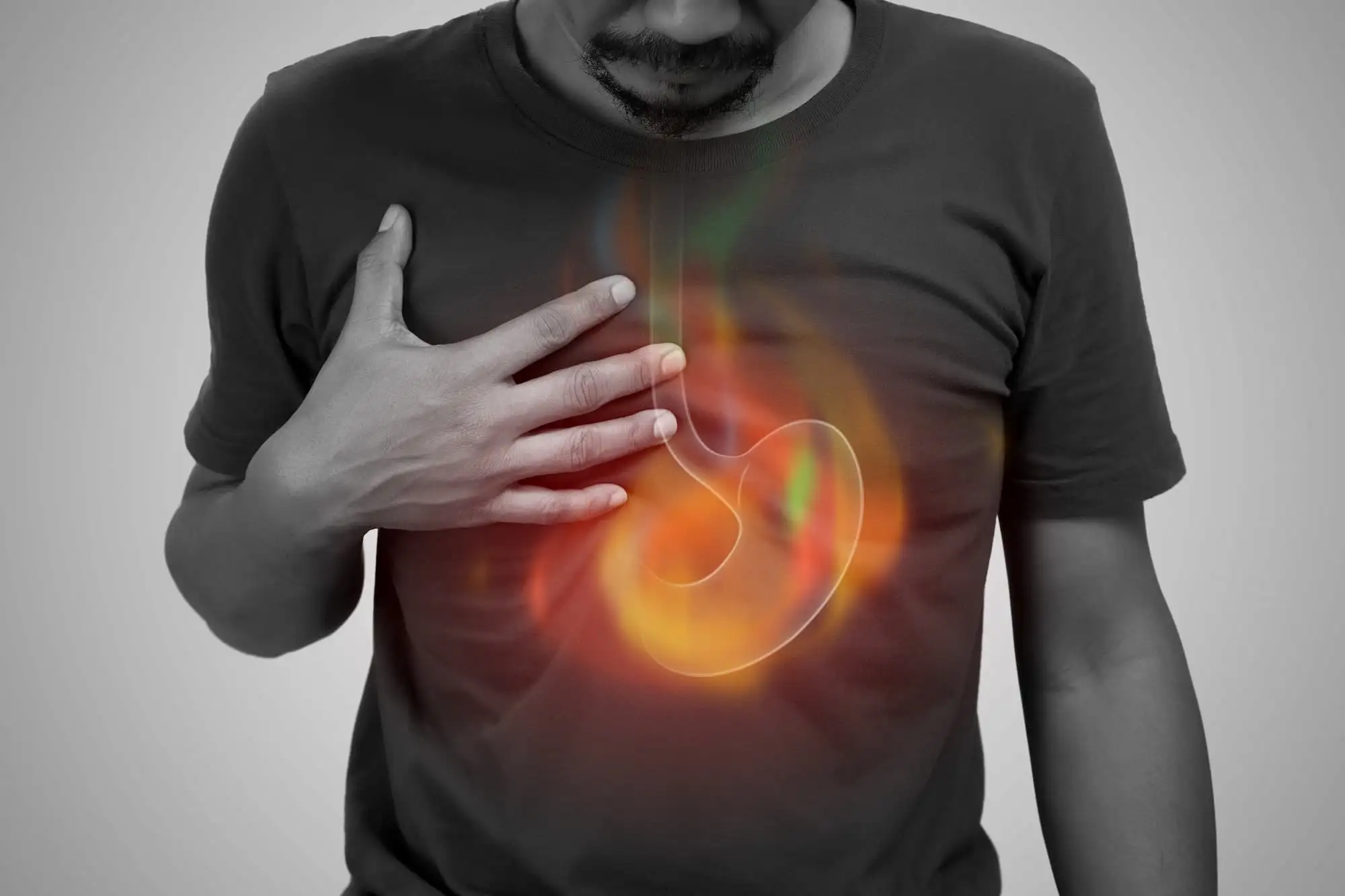 Gastroesophageal reflux disease (GERD)