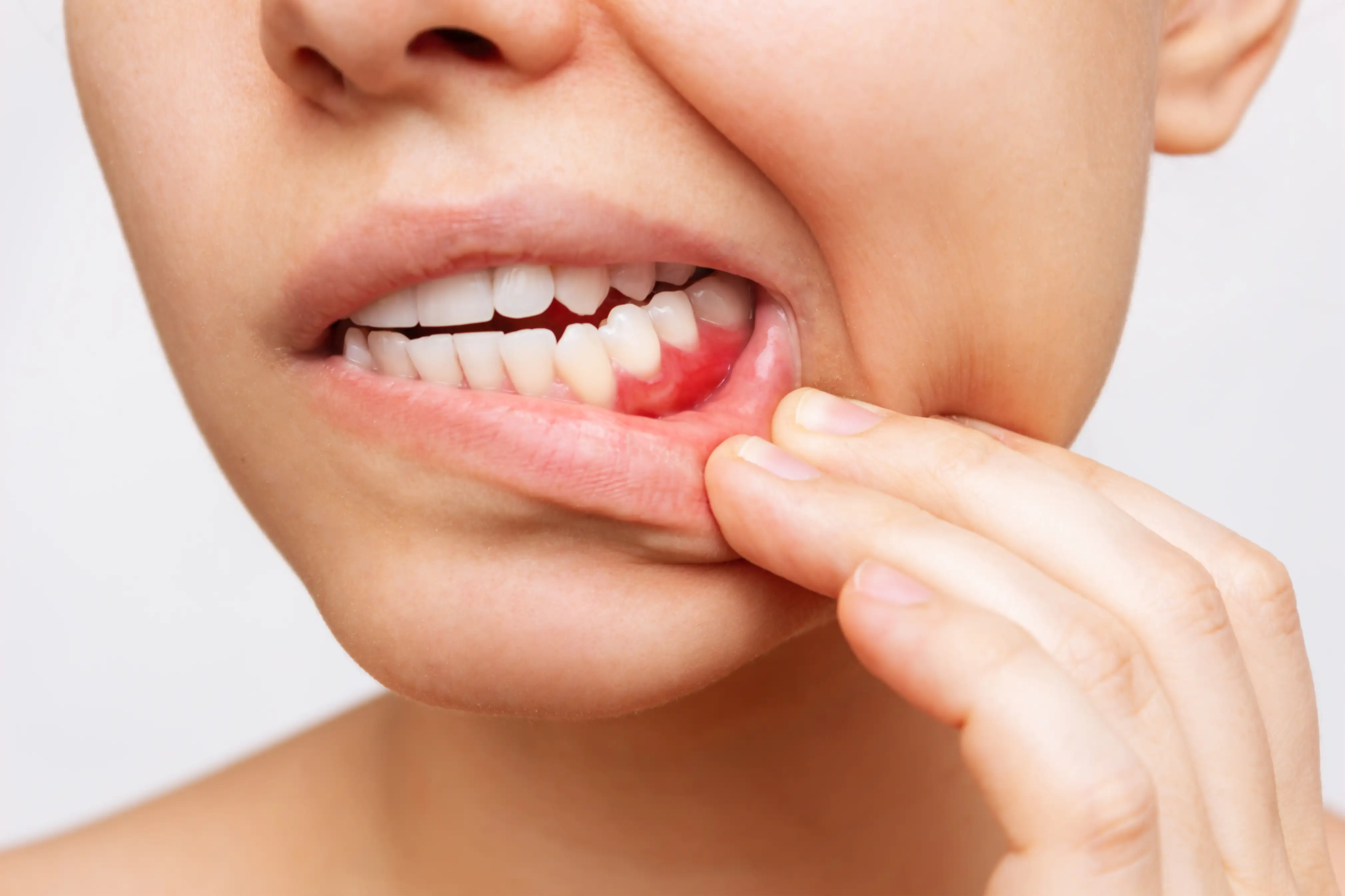 Periodontitis