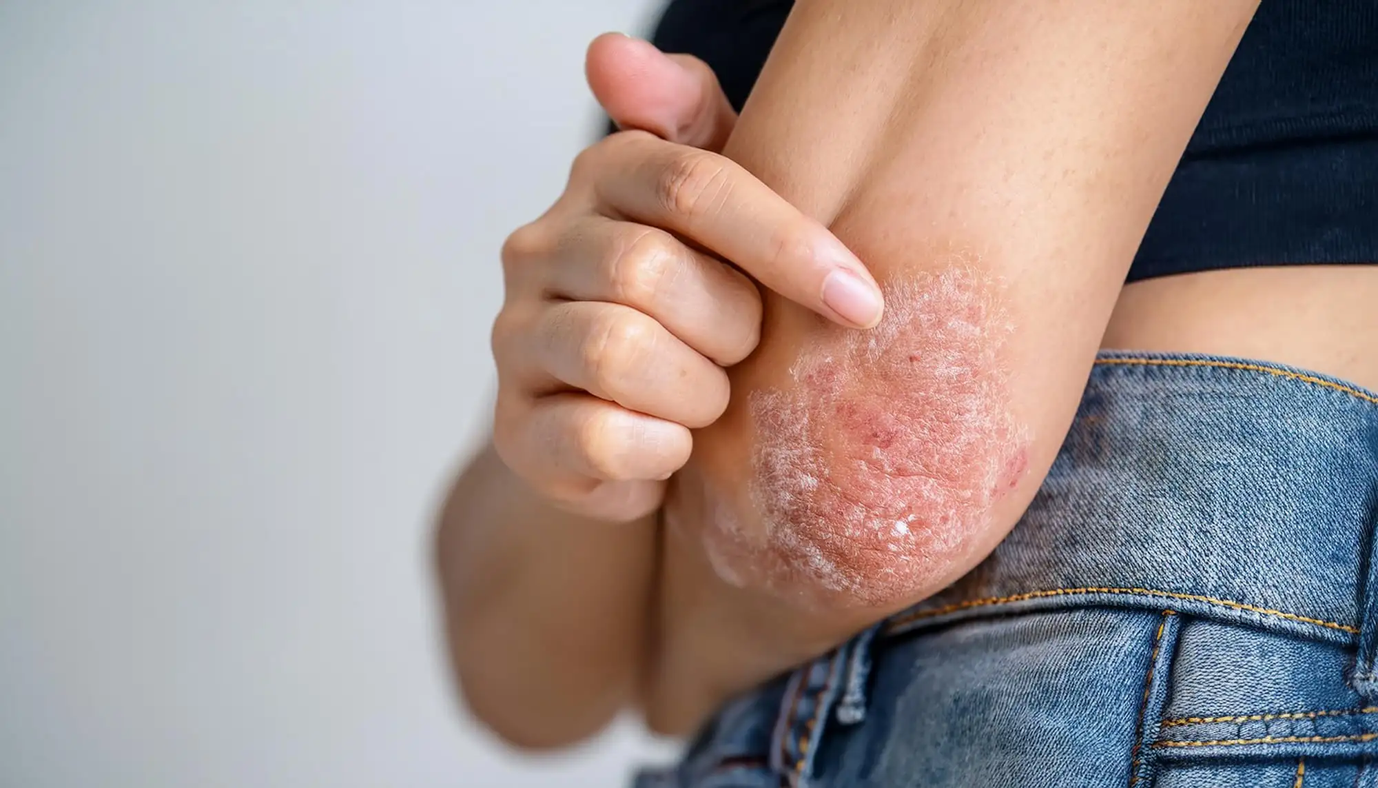 Atopic dermatitis