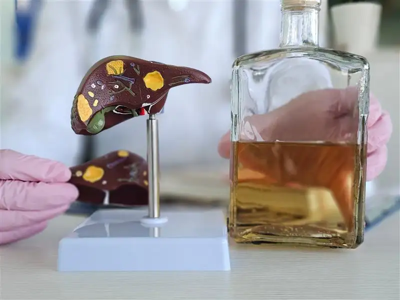Severe alcohol-associated hepatitis