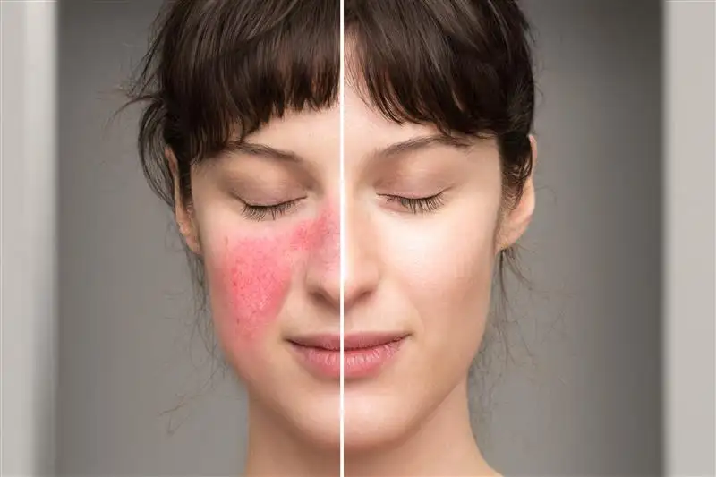Papulopustular rosacea