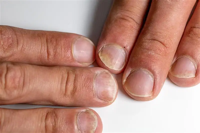 Fingernail onychomycosis