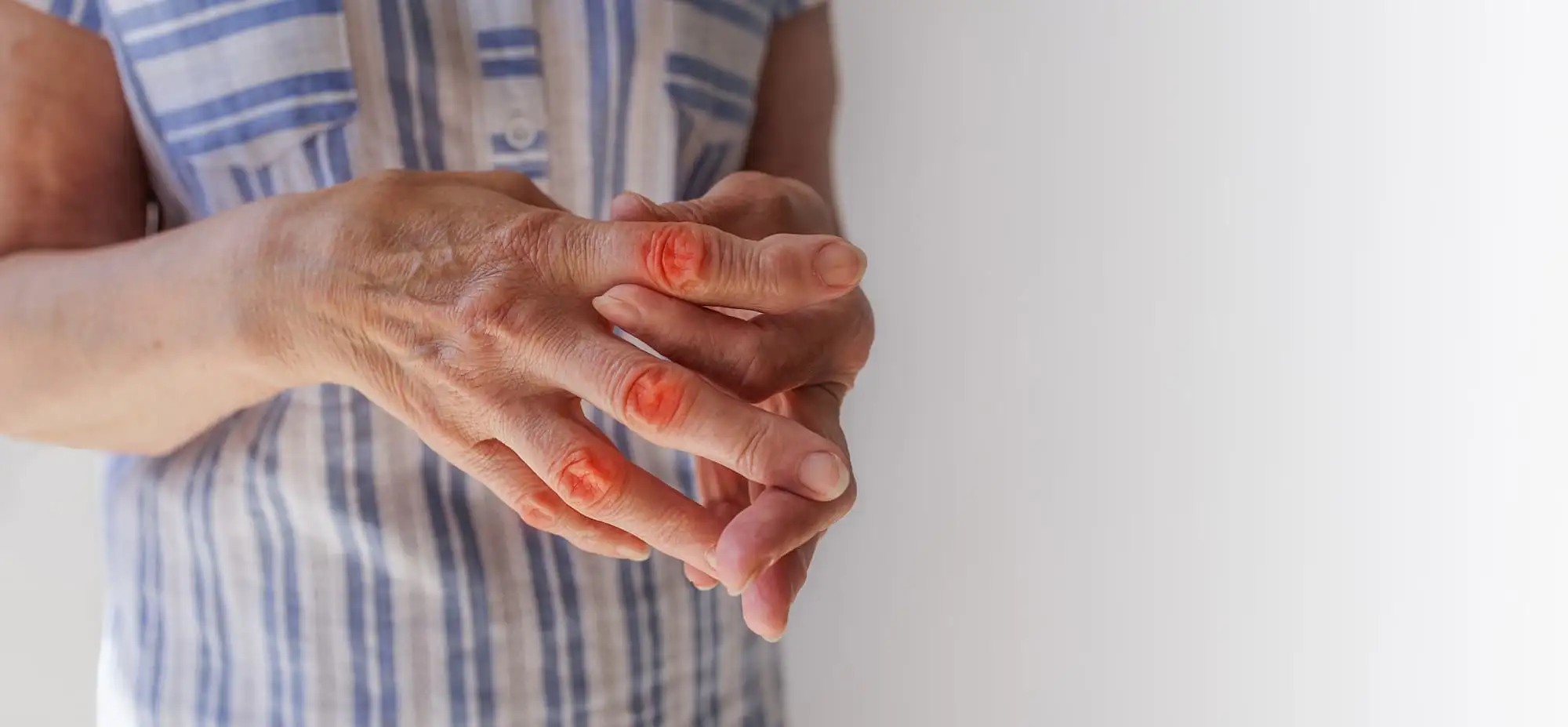 Rheumatoid arthritis