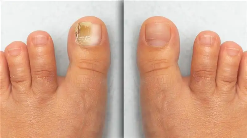 Onychomycosis