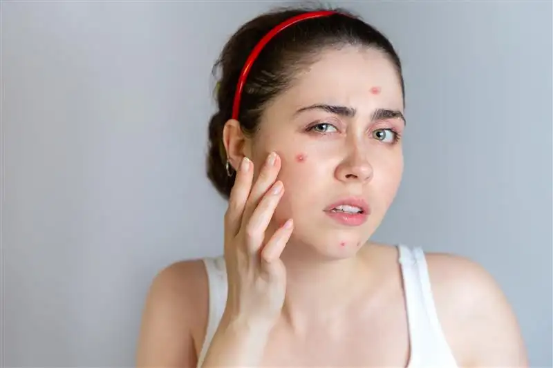 Moderate-to-severe acne vulgaris