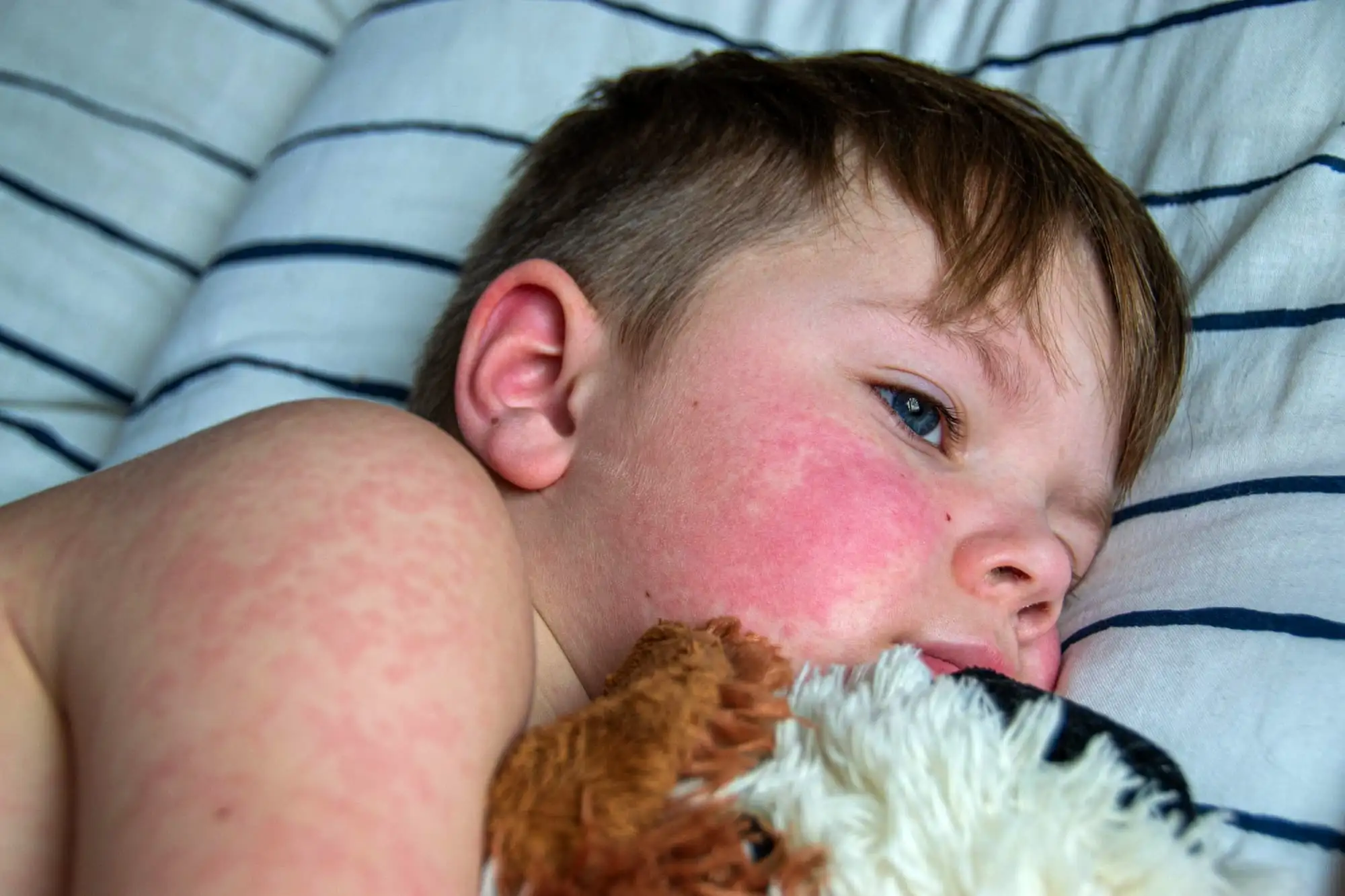 Cow's milk protein allergy