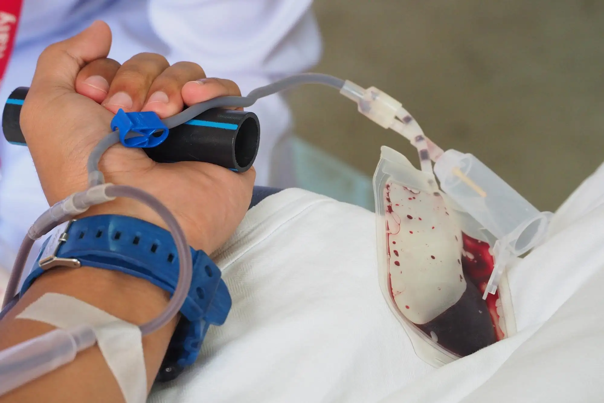 Venoarterial extracorporeal membrane oxygenation (VA-ECMO)