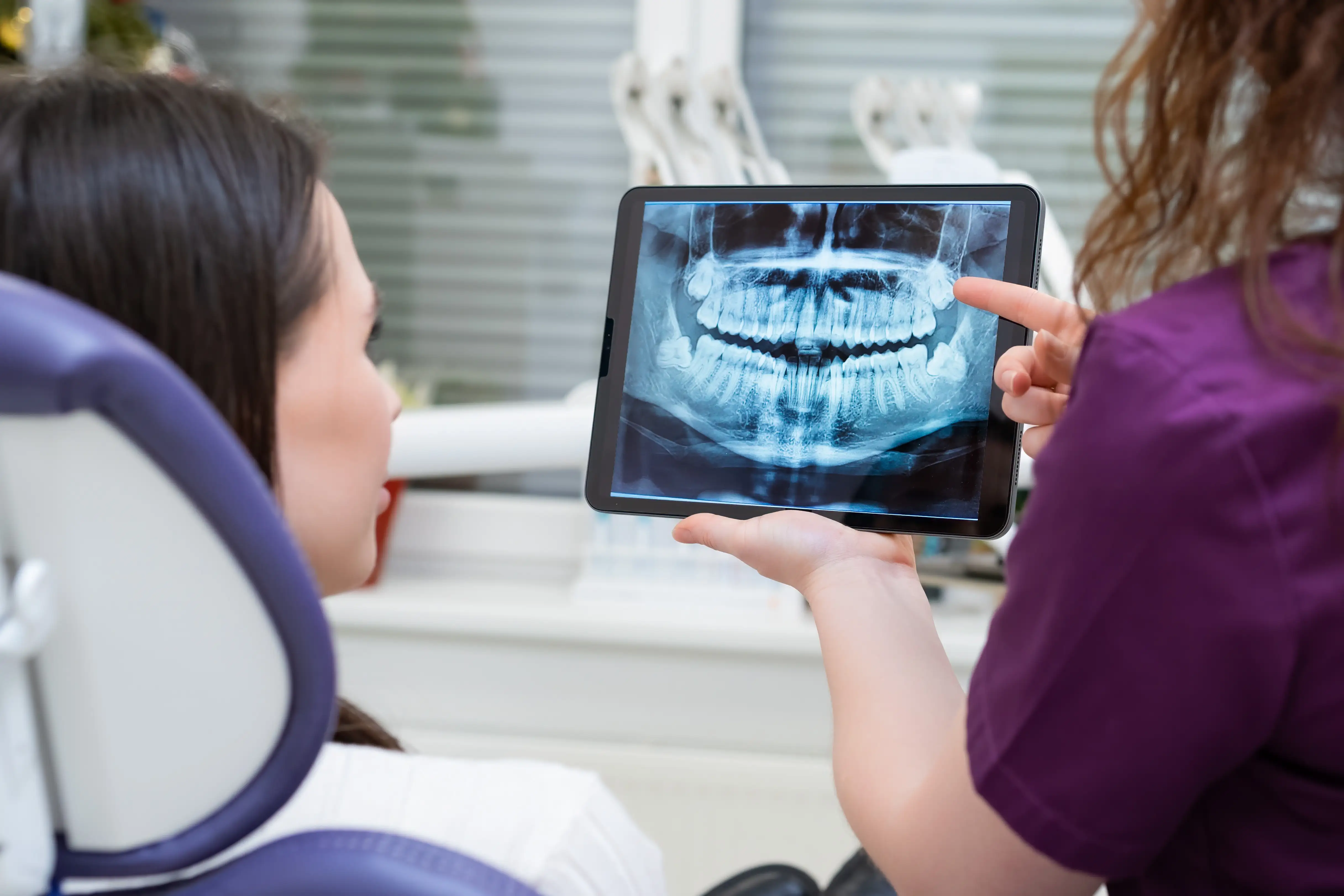 Enamel caries