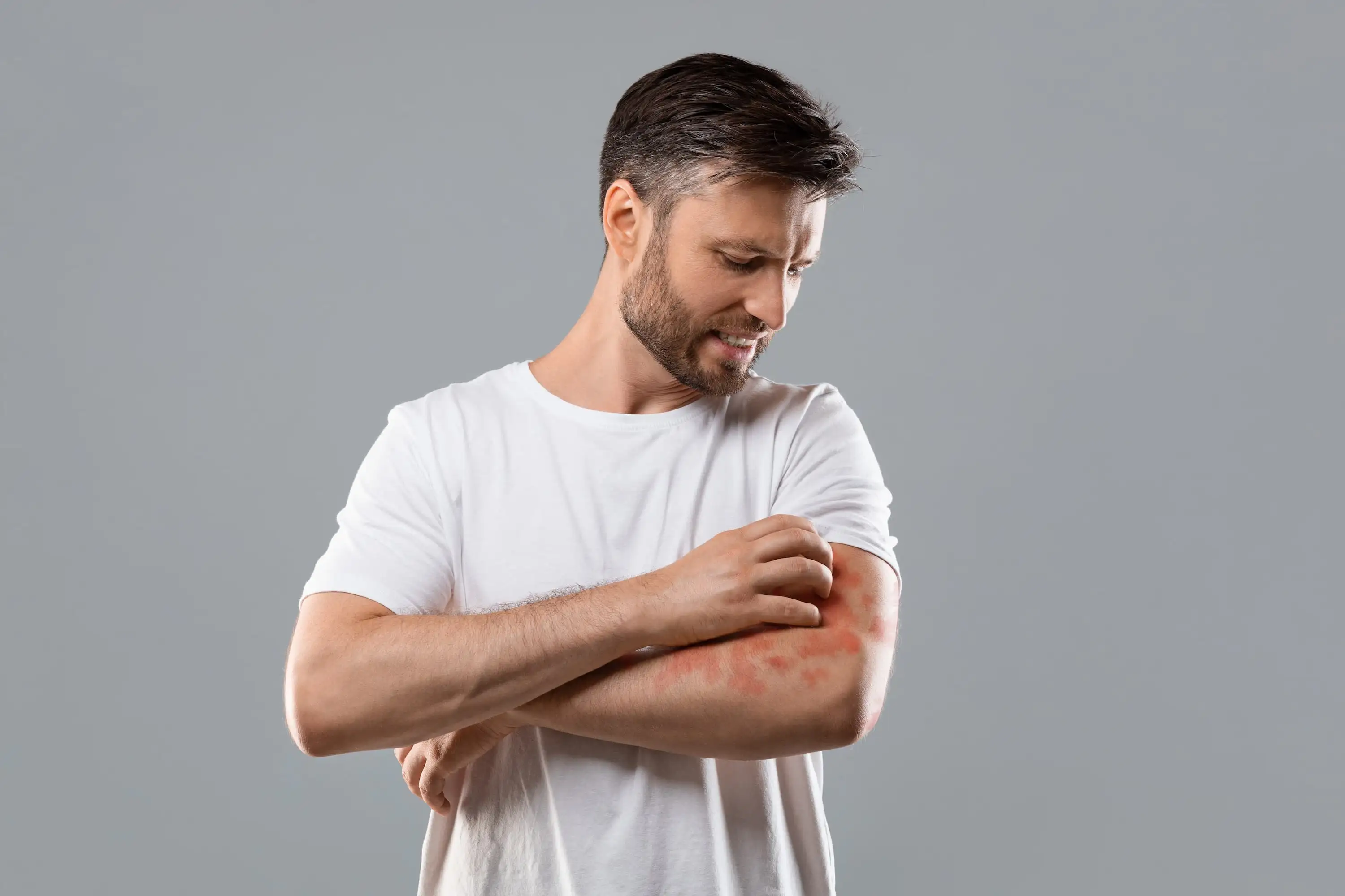 Atopic dermatitis