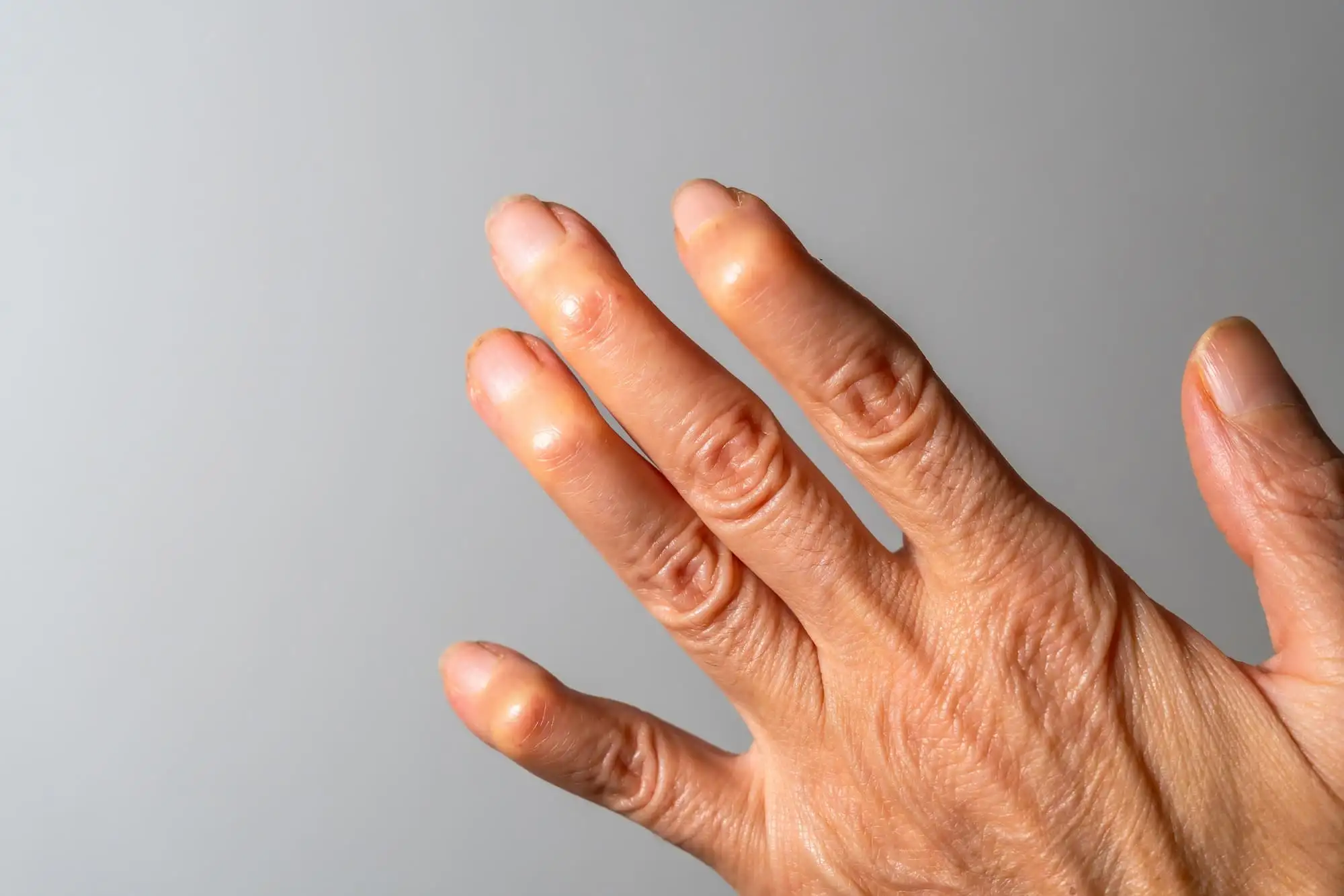 Chronic rheumatoid arthritis, Systemic lupus erythematosus