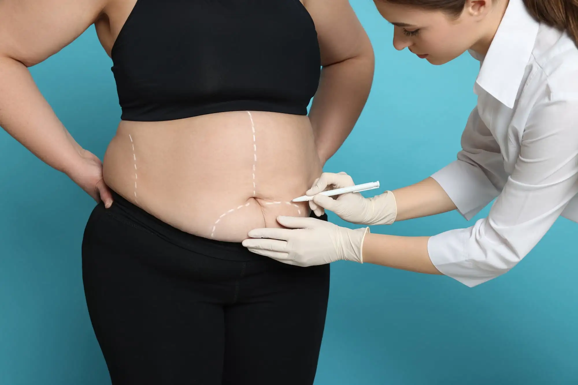 Bariatric surgery