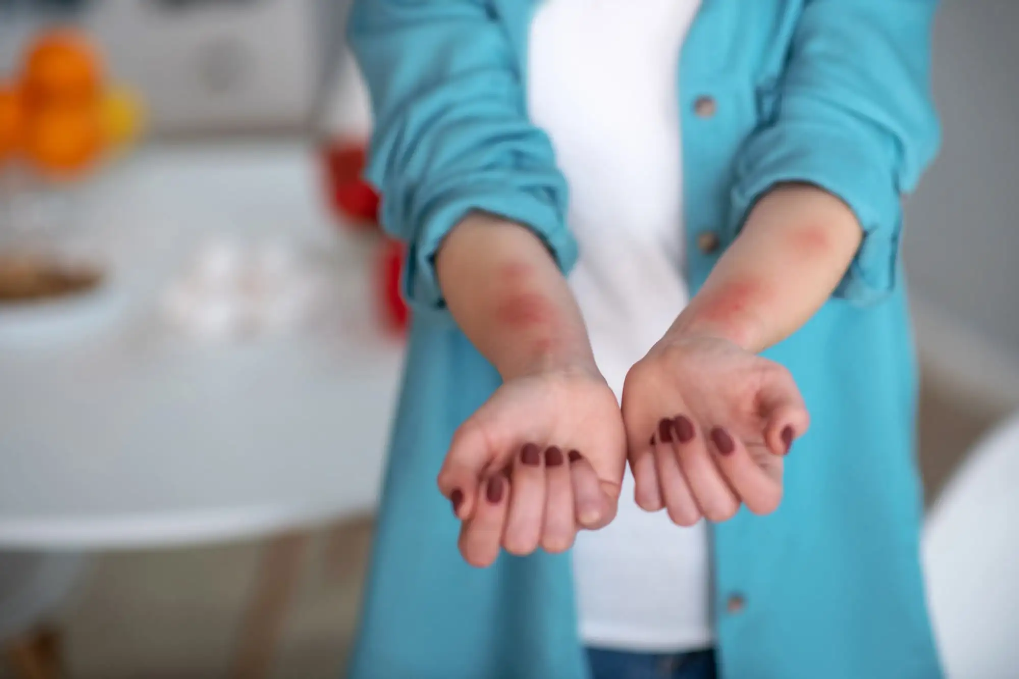 Chronic spontaneous urticaria