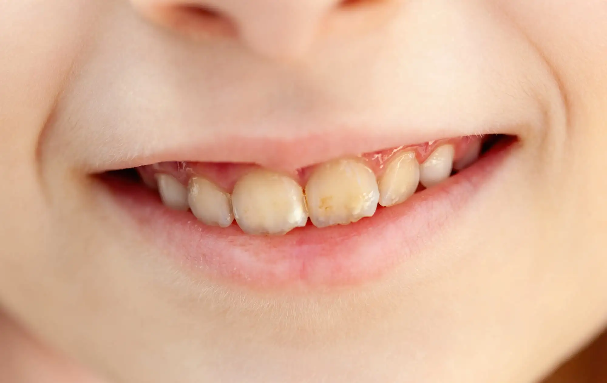 Molar-incisor hypomineralization