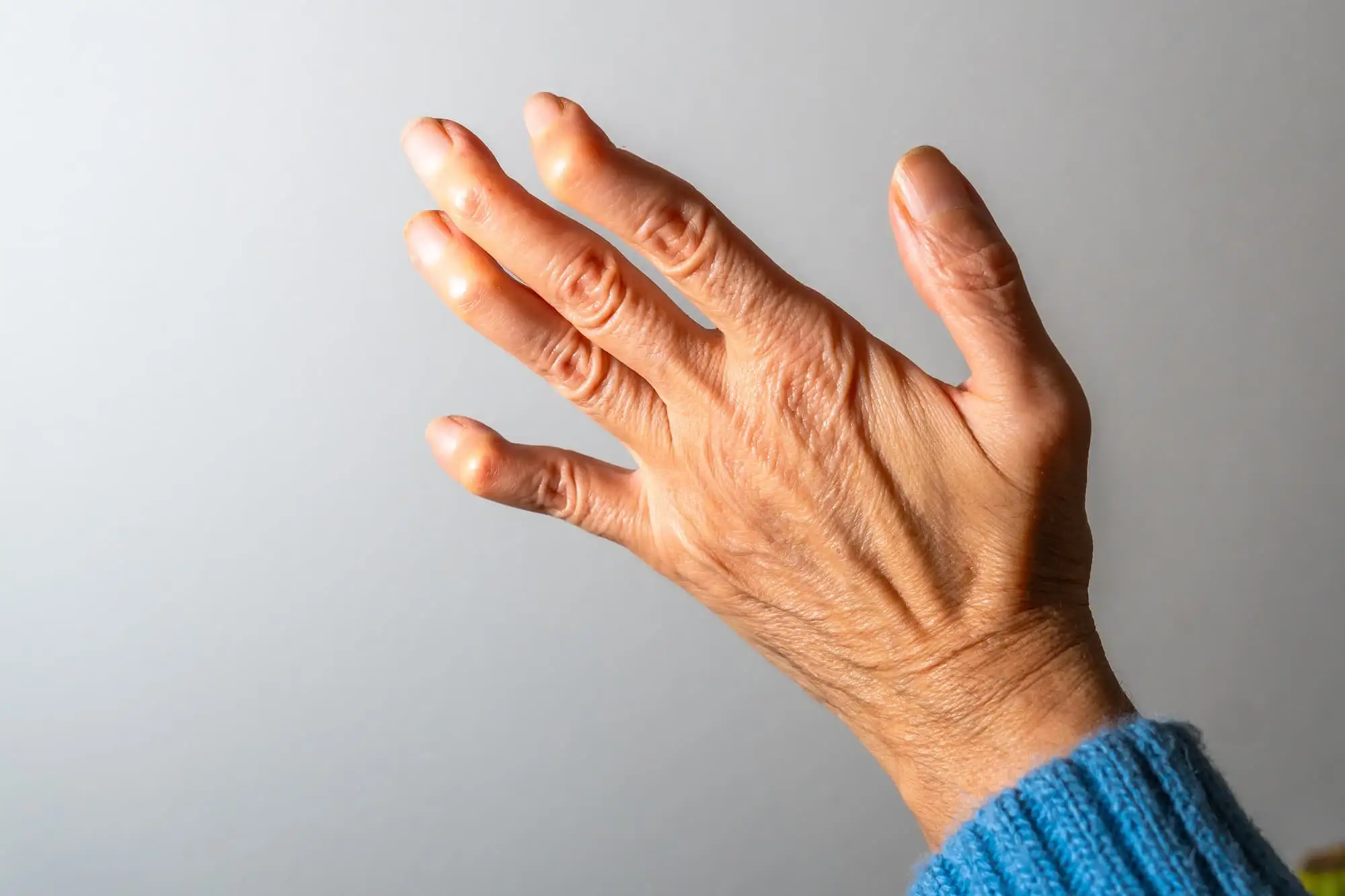 Rheumatoid arthritis