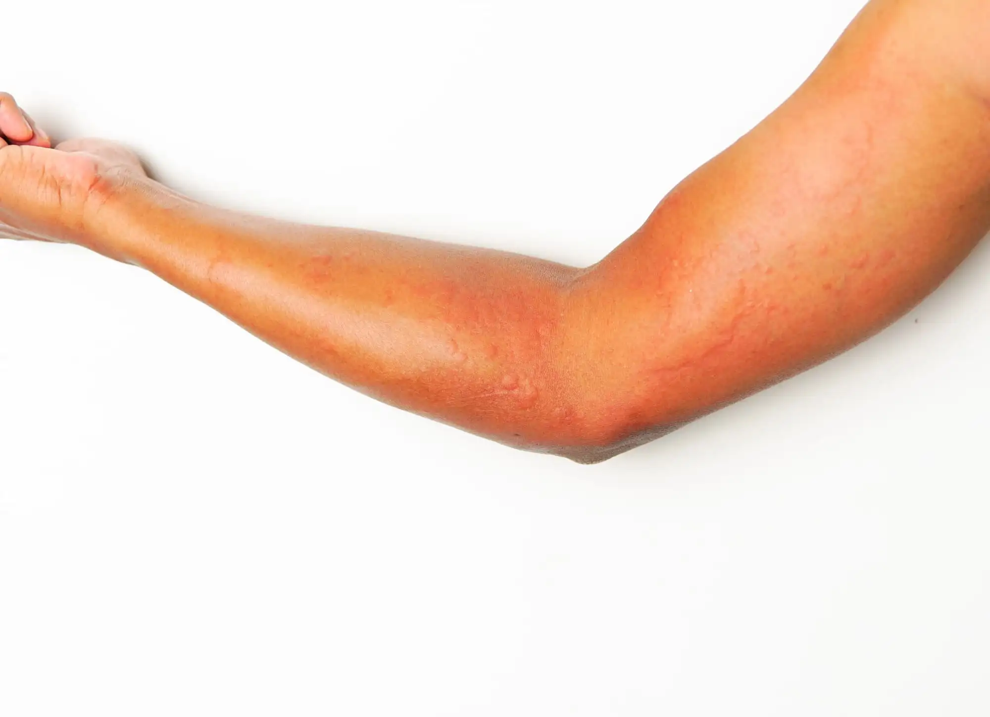 Urticaria