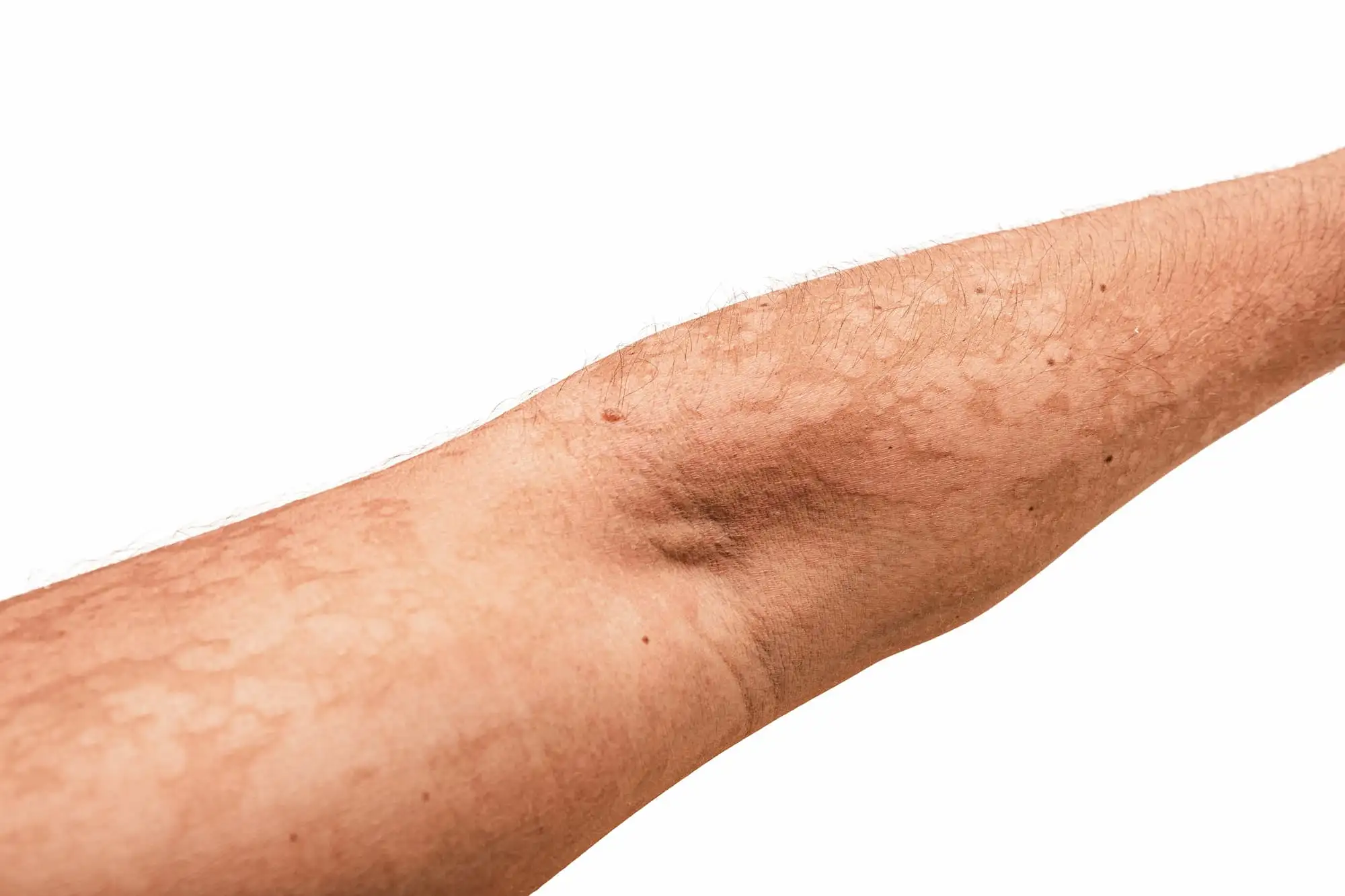 Pityriasis versicolor