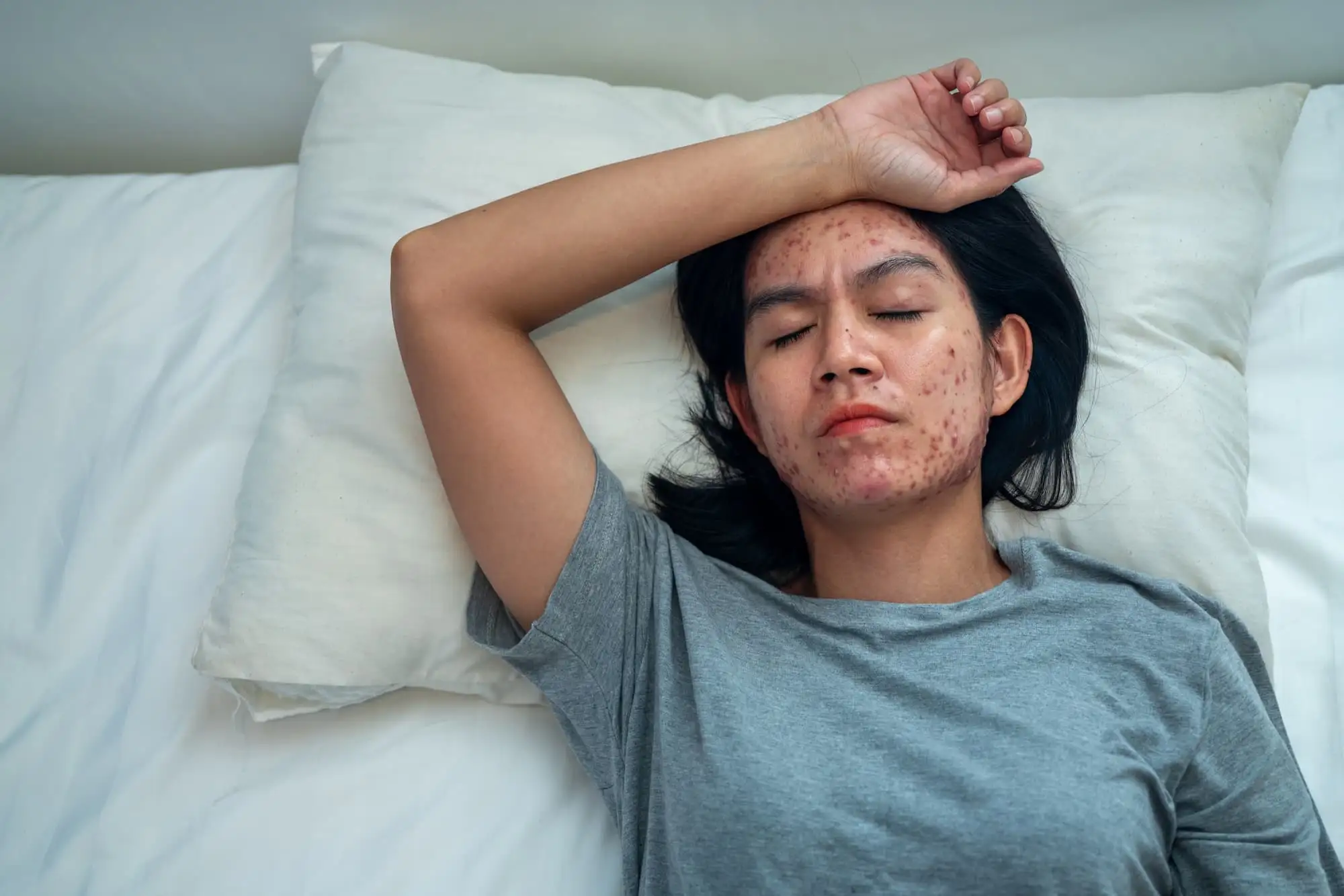 PCOS-related acne vulgaris