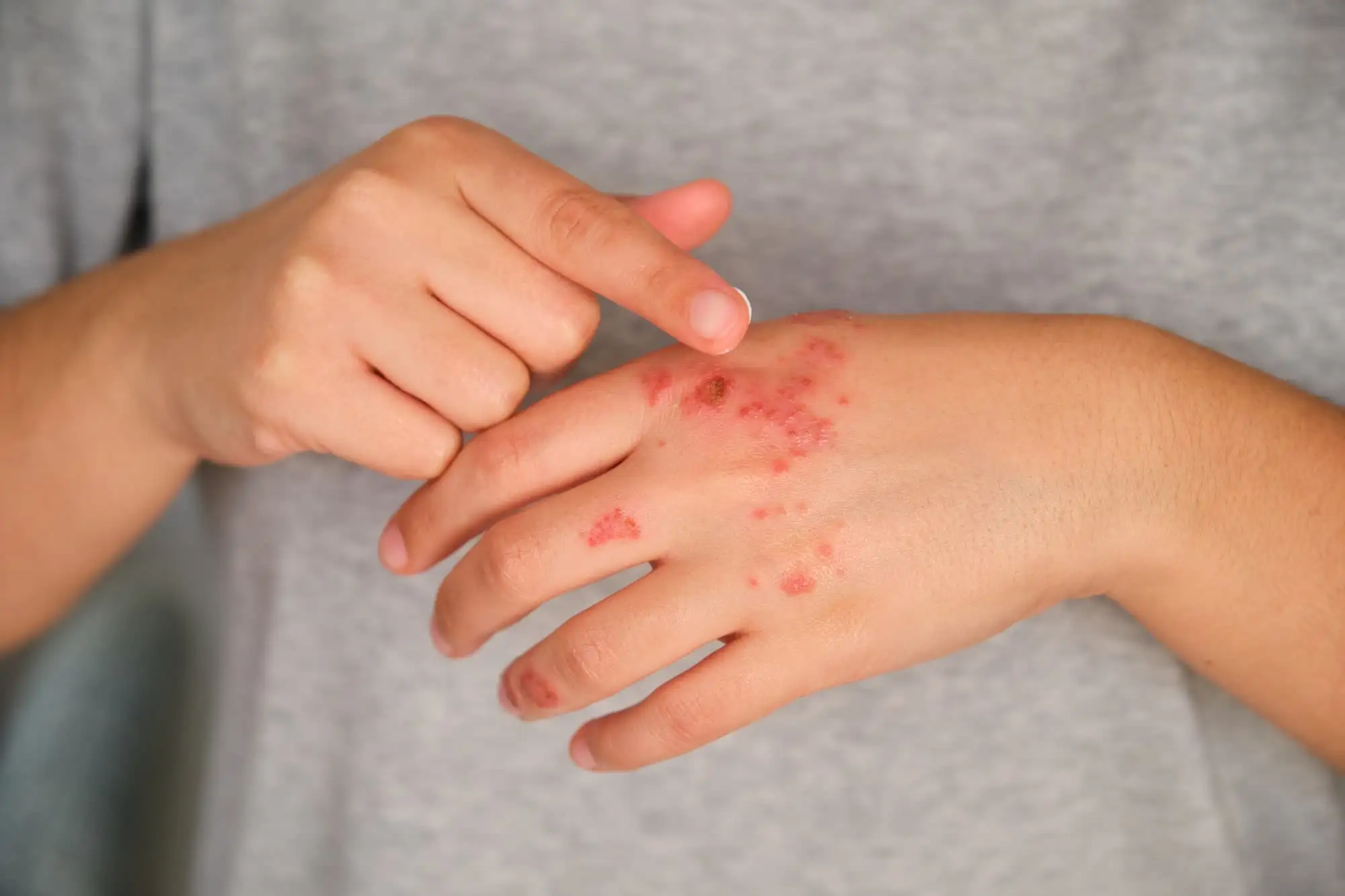 Atopic dermatitis